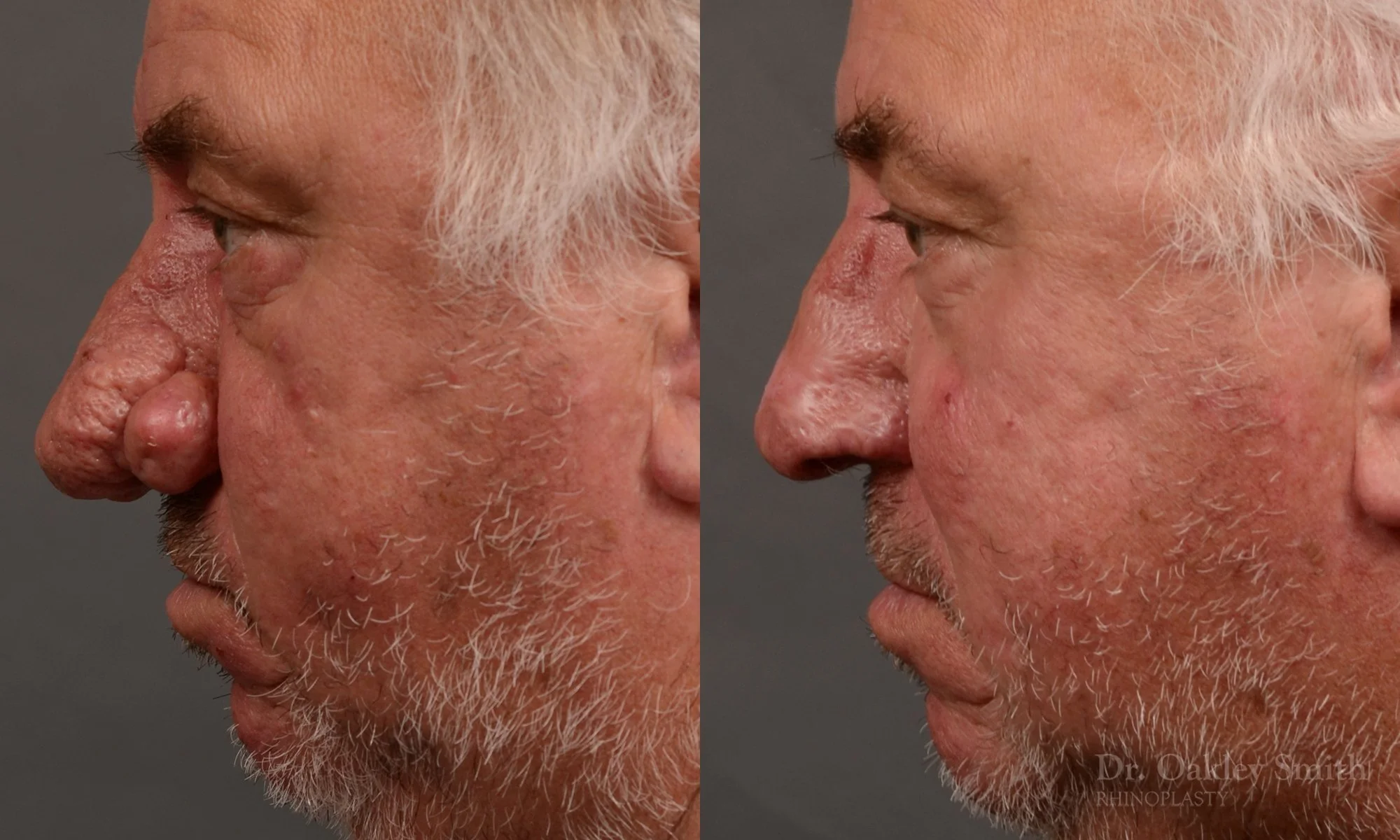 471E-rhinoplasty-septoplastry-dr-oakley-smith-toronto-top-surgeon-nose-job.jpg