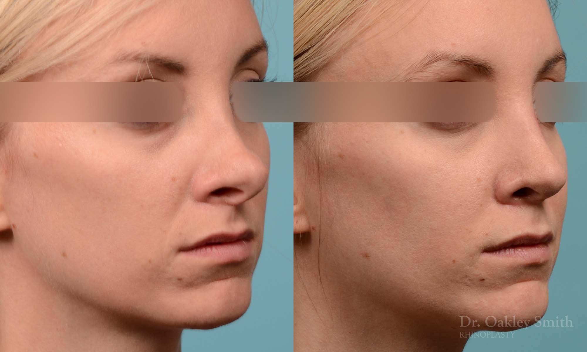 280B-rhinoplasty-dr-oakley-smith-toronto-nose-job.jpg