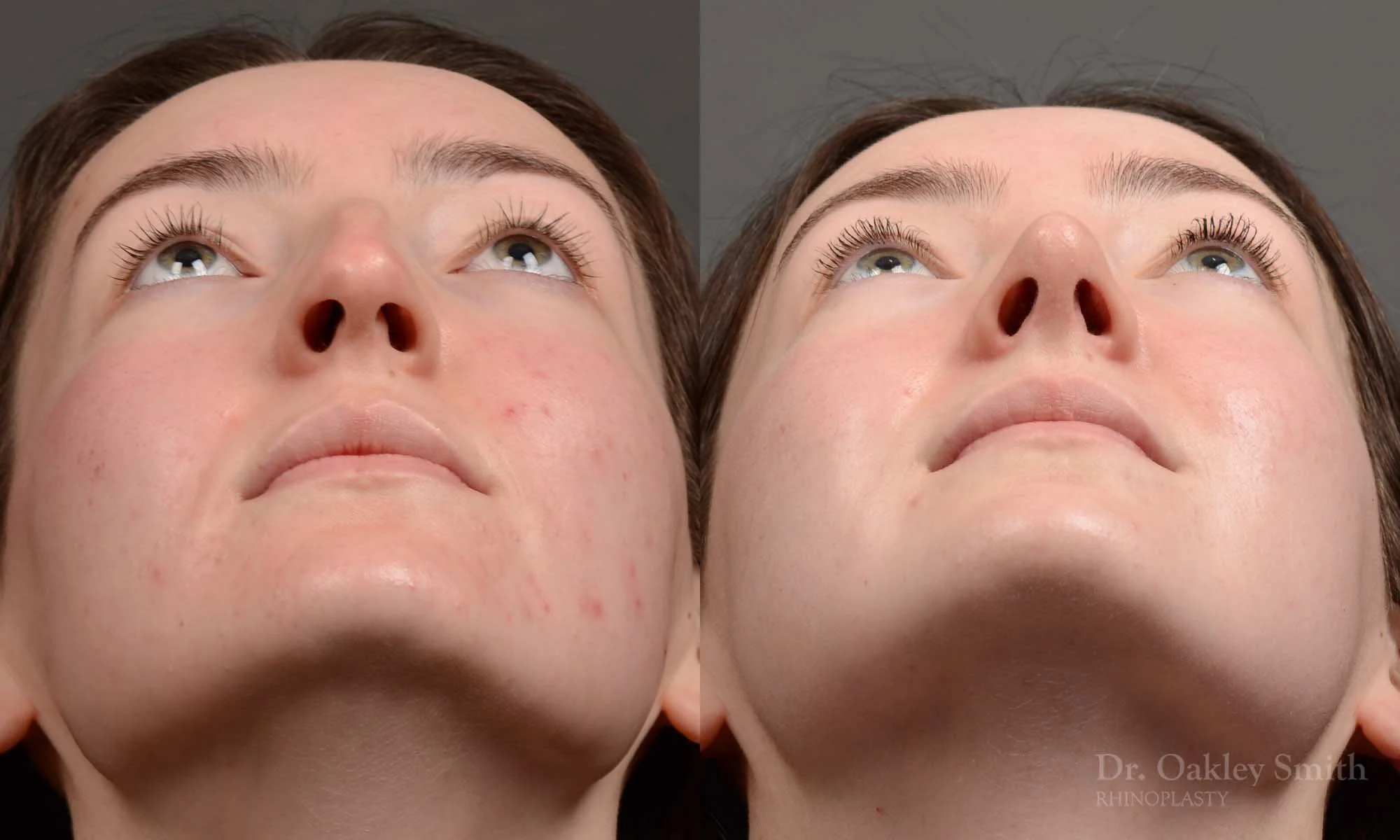 Case 601 Dr. Oakley Smith, preservation rhinoplasty, 12 months after surgery,  submental view