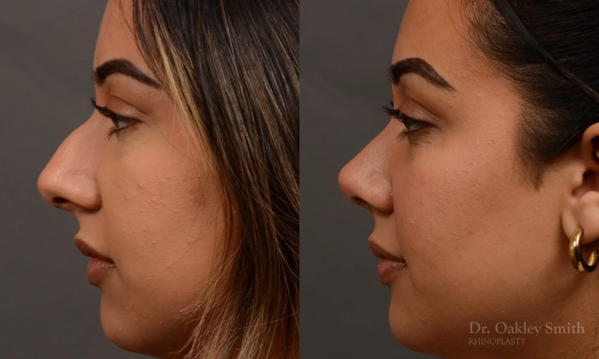 52EB-rhinoplasty-dr-oakley-smith-toronto-top-surgeon-nose-job.jpg
