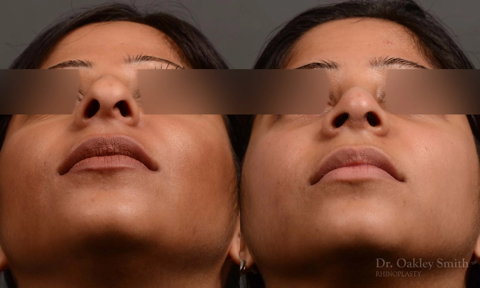 346F-rhinoplasty-dr-oakley-smith-toronto-nose-job.jpg