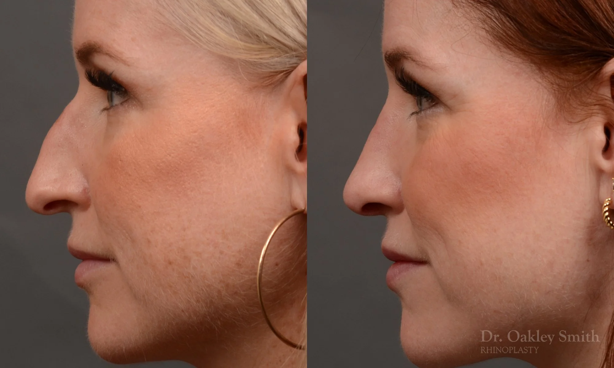 528E-rhinoplasty-dr-oakley-smith-toronto-top-surgeon-nose-job.jpg
