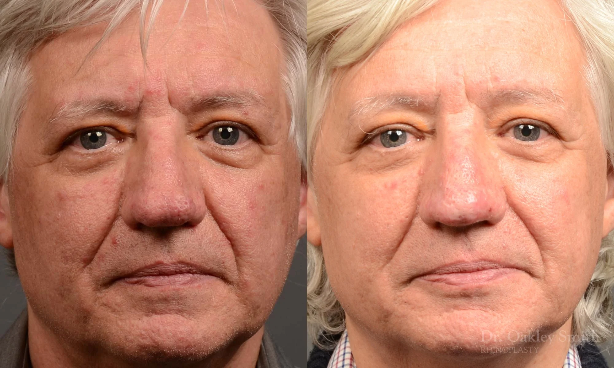 532.1A-Rhinophyma-nose-job-growth-toronto-nose-surgeon-dr-oakley-smith.jpg