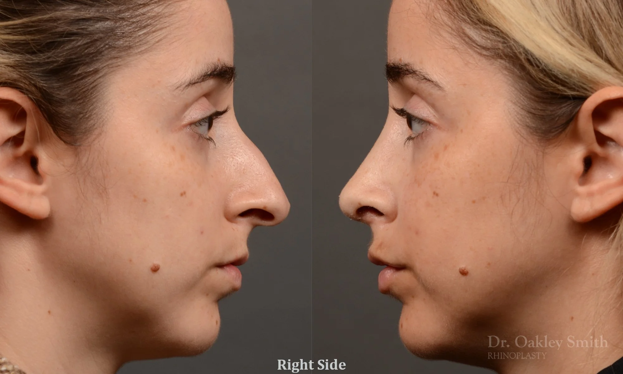 286C-rhinoplasty-dr-oakley-smith-toronto-nose-job.jpg