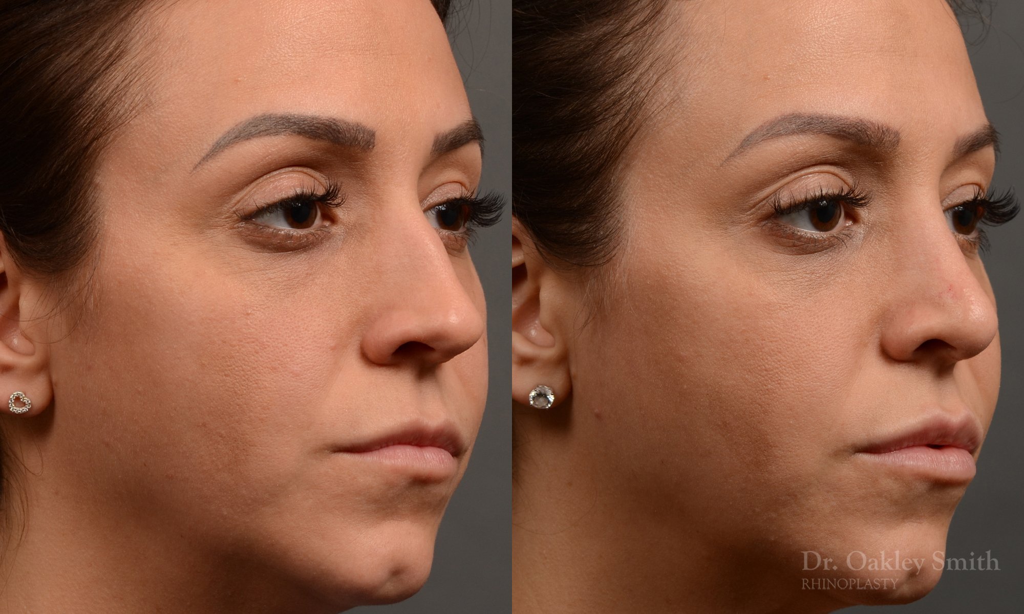 353B-rhinoplasty-dr-oakley-smith-toronto-nose-job.jpg
