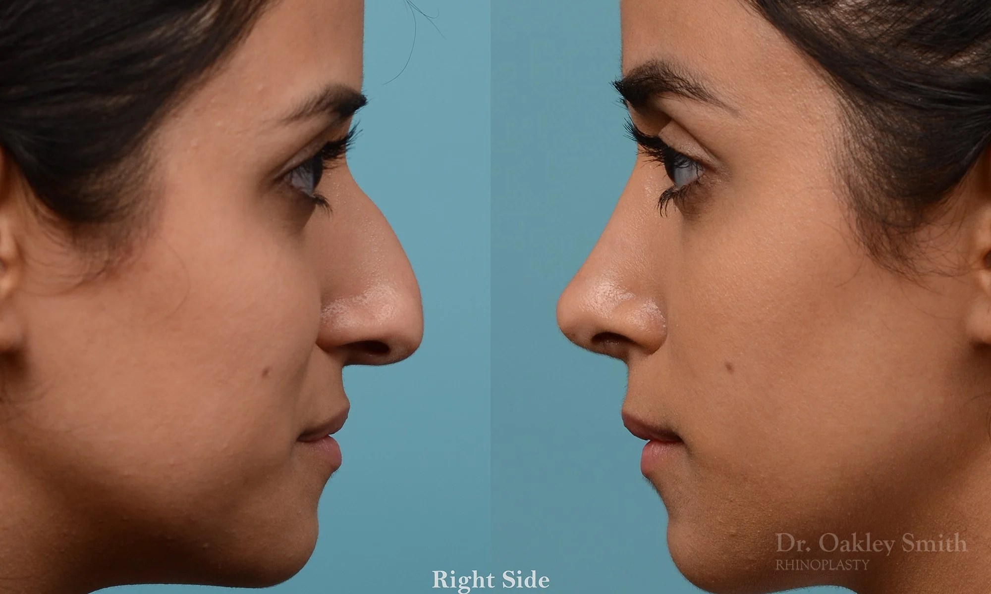 228: Female, Ethnic Rhinoplasty, Dorsal Hump, Tip Refinement, Crooked
