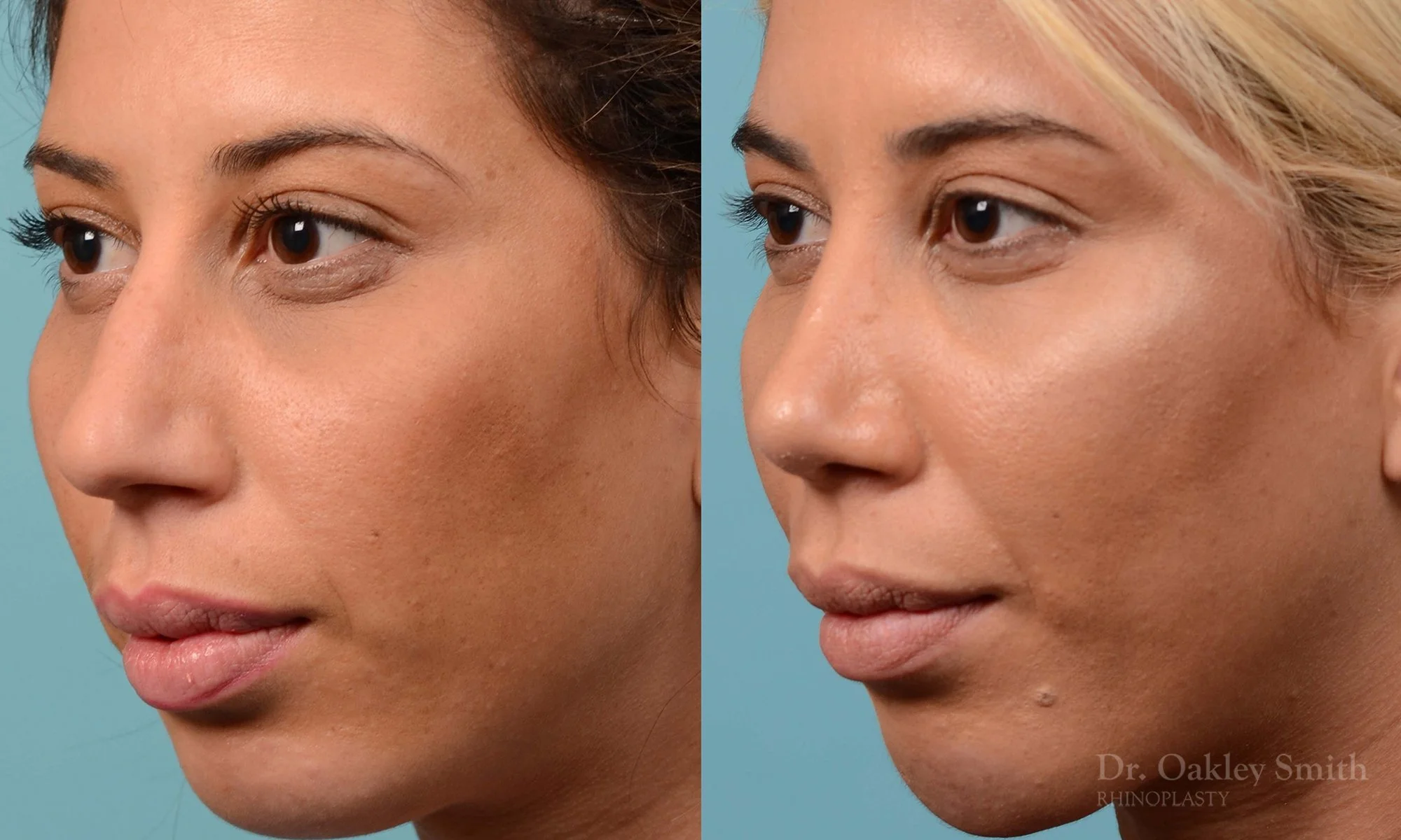 200D-nose-job-rhinoplasty-toronto-dr.-oakley-smith-septum-2.jpg