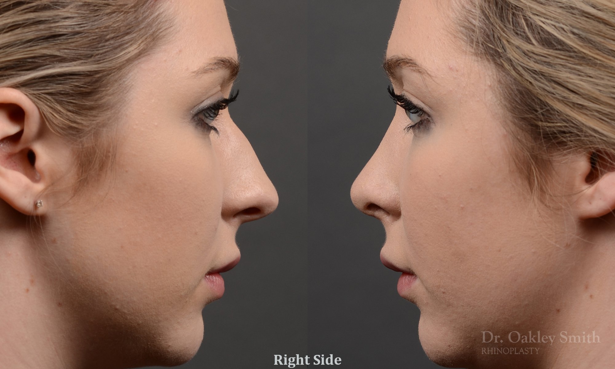 348C-rhinoplasty-dr-oakley-smith-toronto-nose-job.jpg