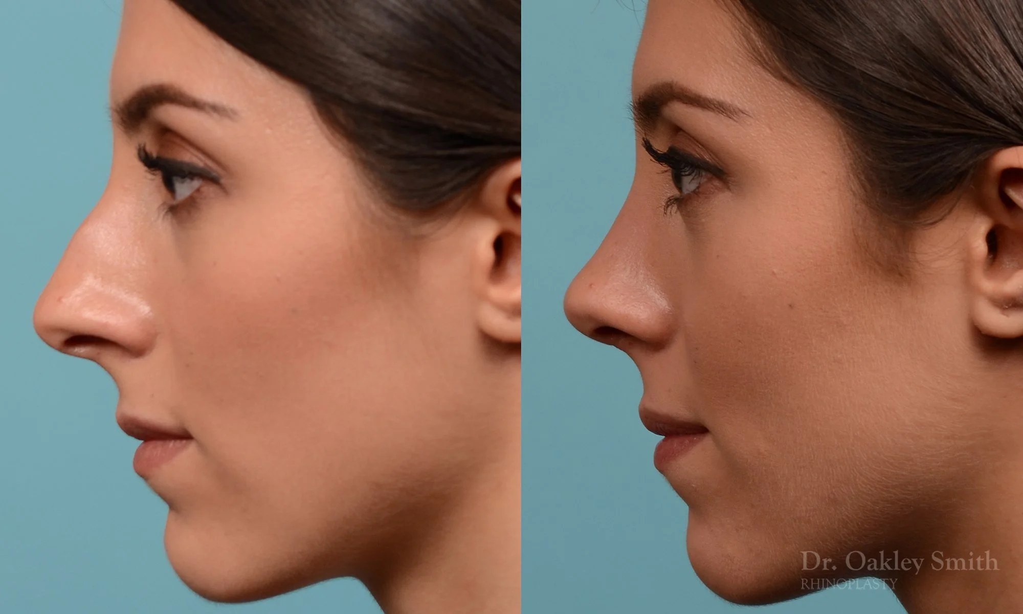 229E-rhinoplasty-oakley-smith-toronto-nose-job-straight-nose-bridge-1.jpg