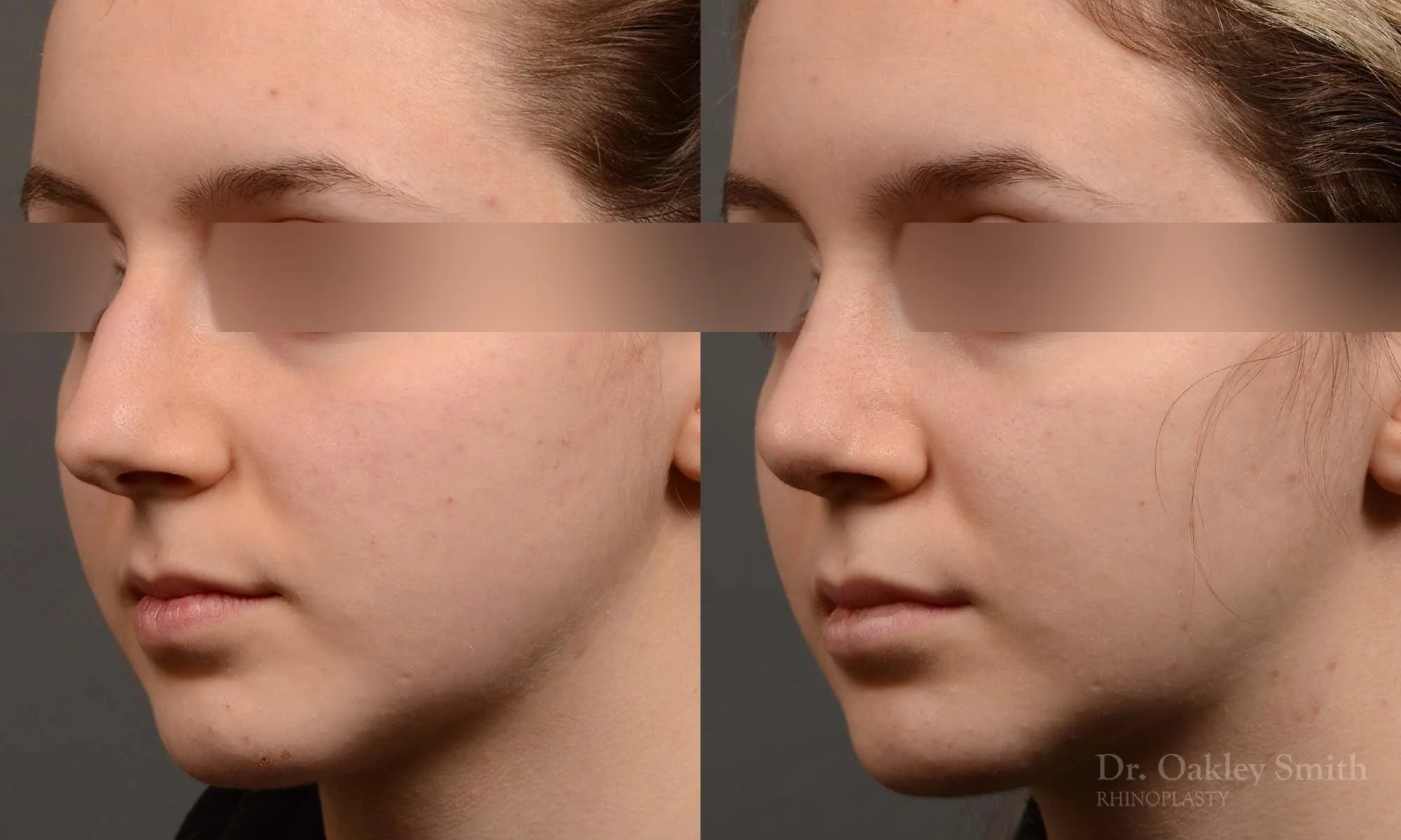326D-rhinoplasty-dr-oakley-smith-toronto-nose-job.jpg