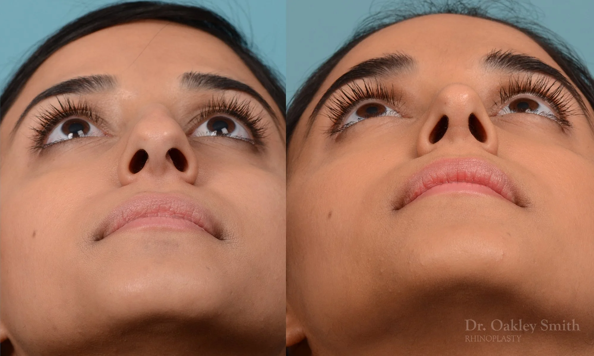 228F-nose-job-rhinoplasty-dr-oakley-smith-toronto-bump-on-the-nose-bridge-bump-4.jpg