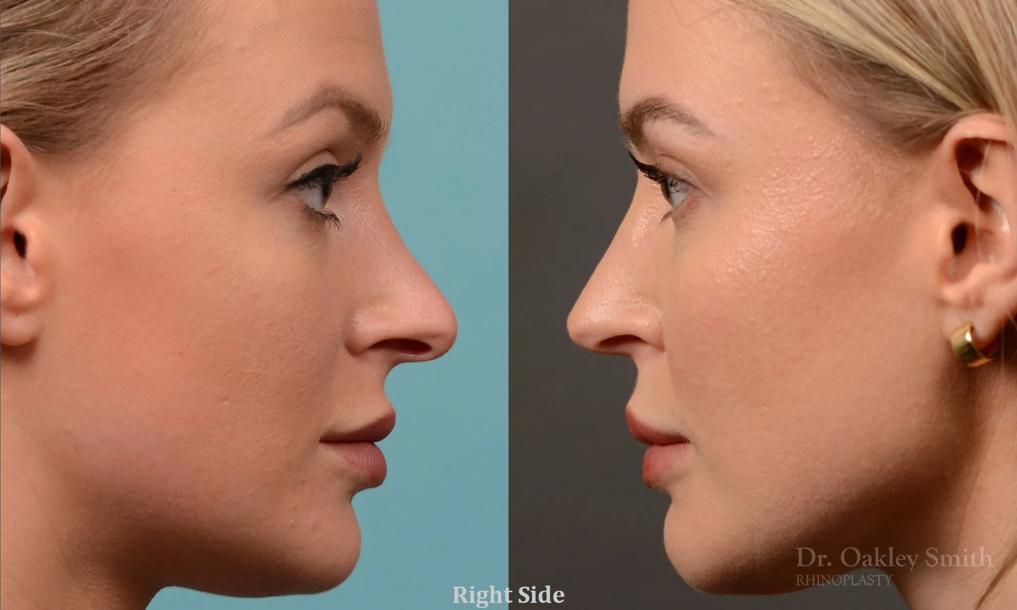 538C-rhinoplasty-dr-oakley-smith-toronto-nose-job.jpg