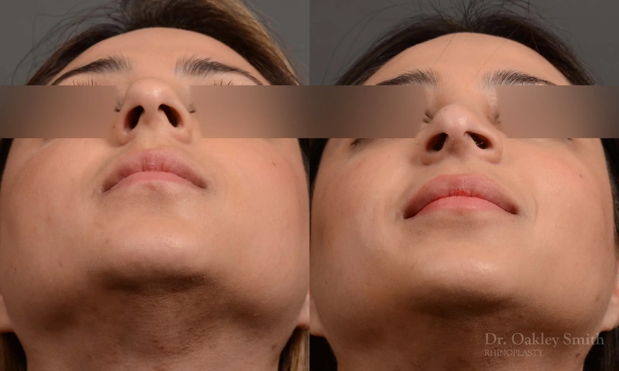 333F-rhinoplasty-dr-oakley-smith-toronto-nose-job.jpg