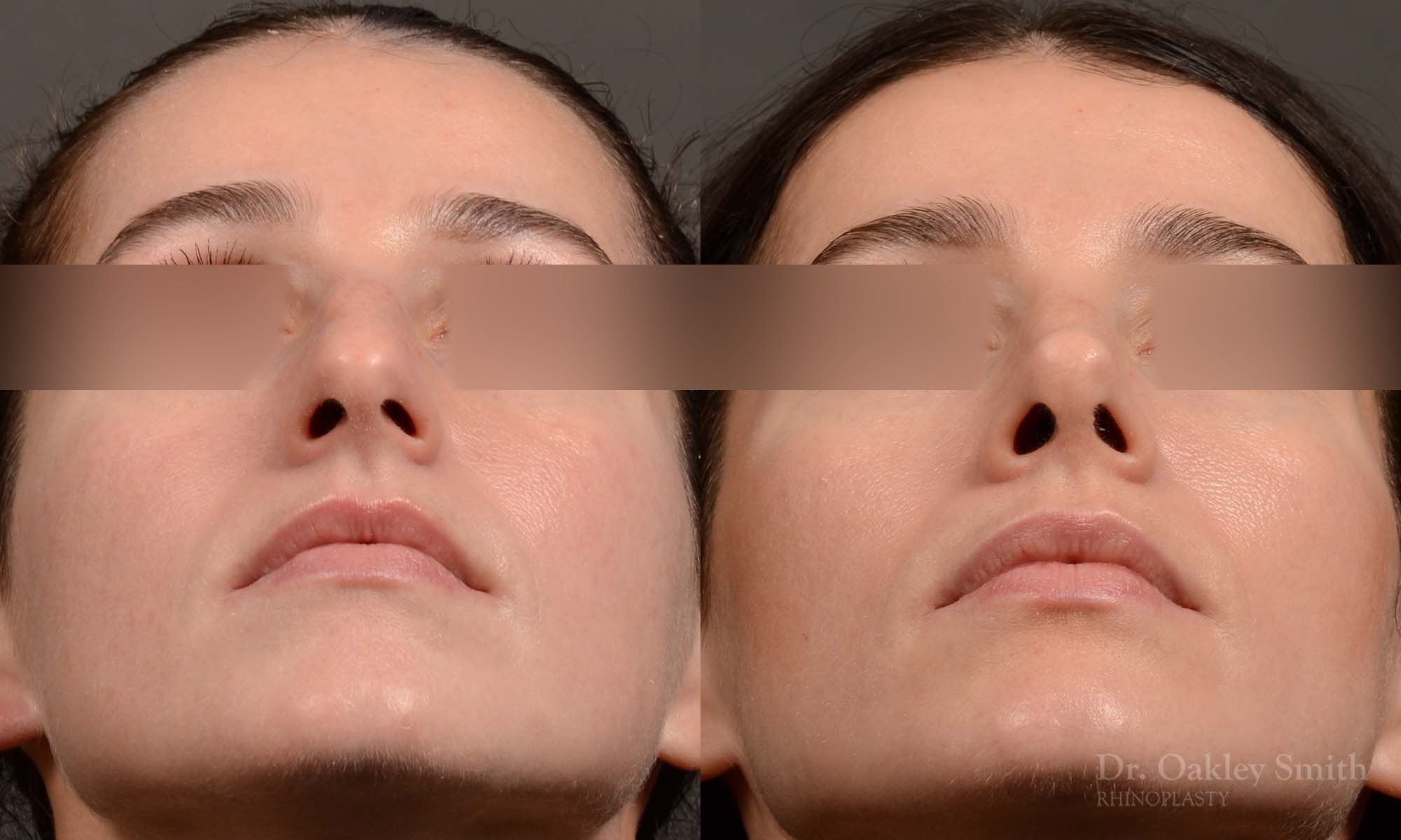 529F-rhinoplasty-dr-oakley-smith-toronto-top-surgeon-nose-job.jpg