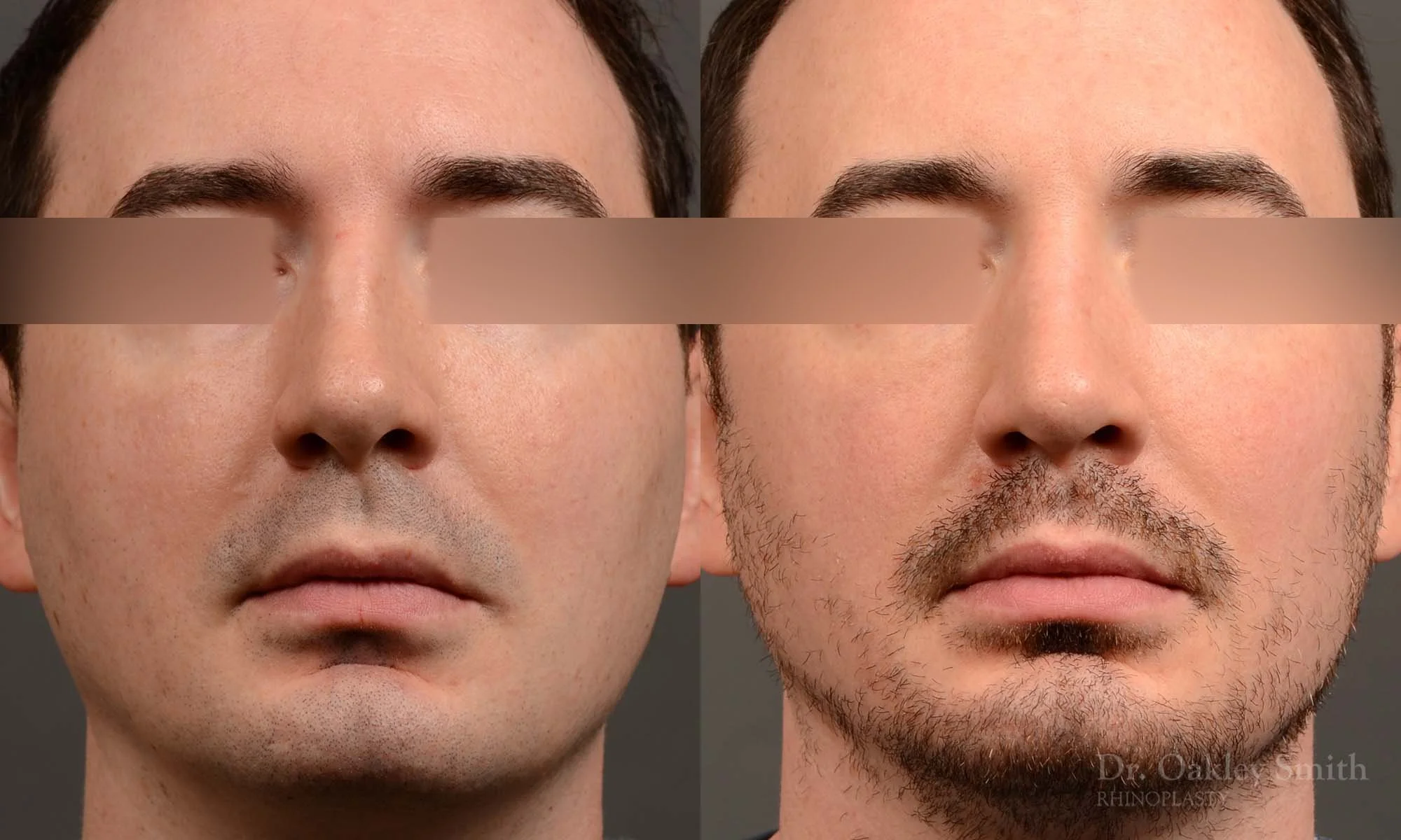555A male rhinoplasty, nose job, toronto nose surgeon, dr oakley smith.jpg