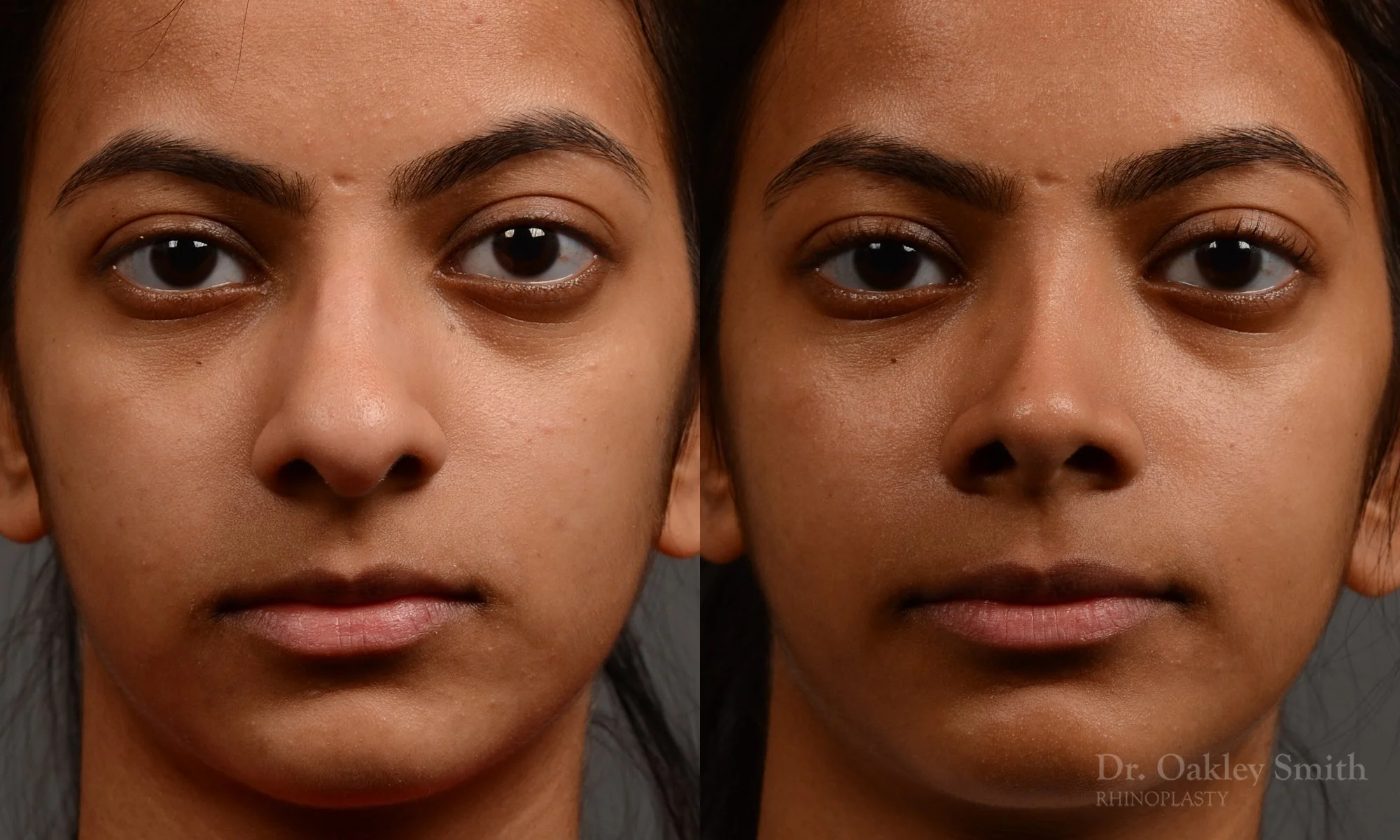399A-expert-rhinoplasty-dr-oakley-smith-toronto-nose-job.jpg