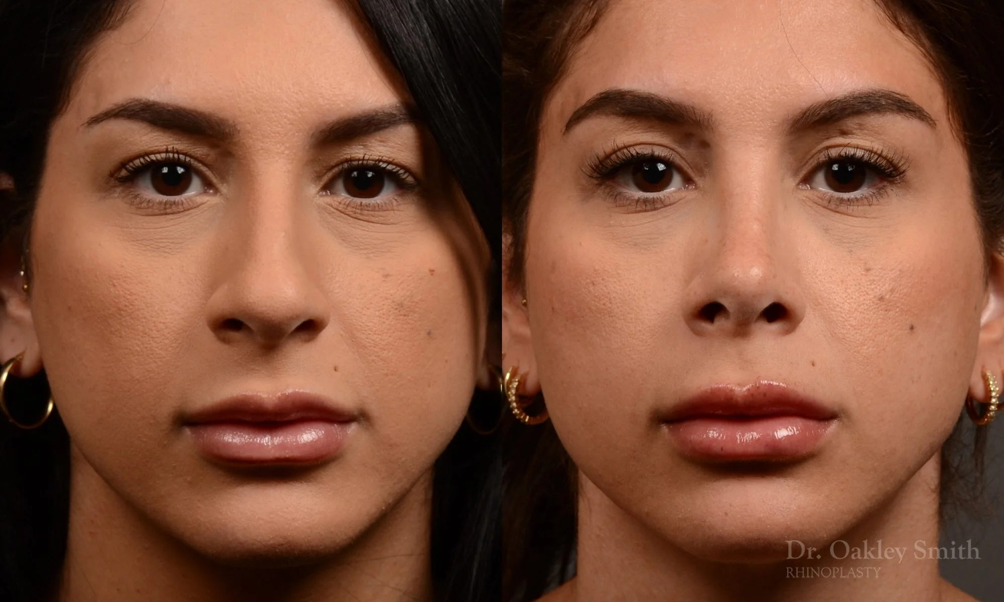 540A-rhinoplasty-dr-oakley-smith-toronto-nose-job.jpg