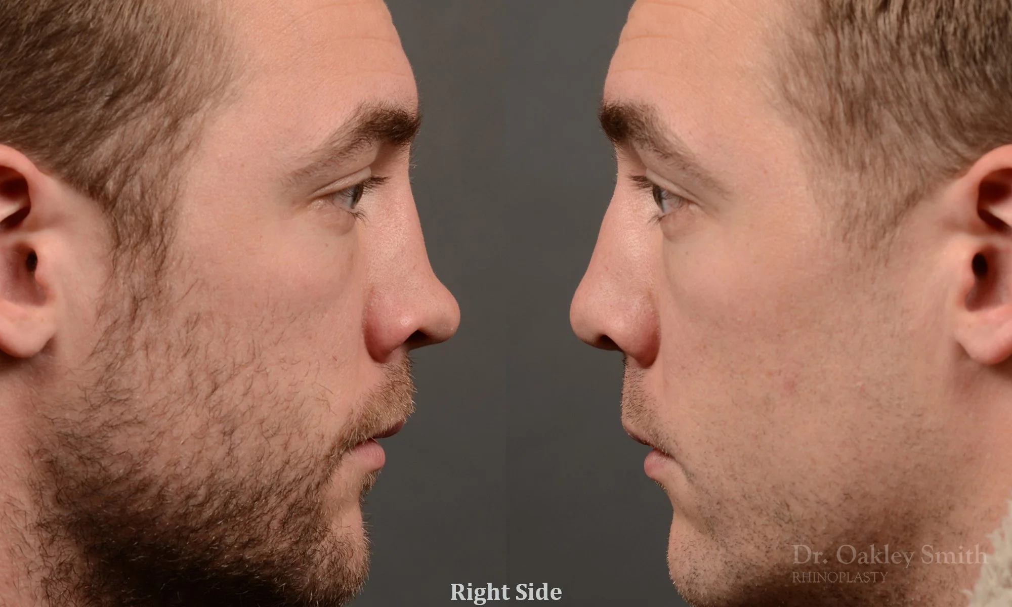 388: Primary Male Rhinoplasty, Normal Skin, Saddle Nose, Tip Work