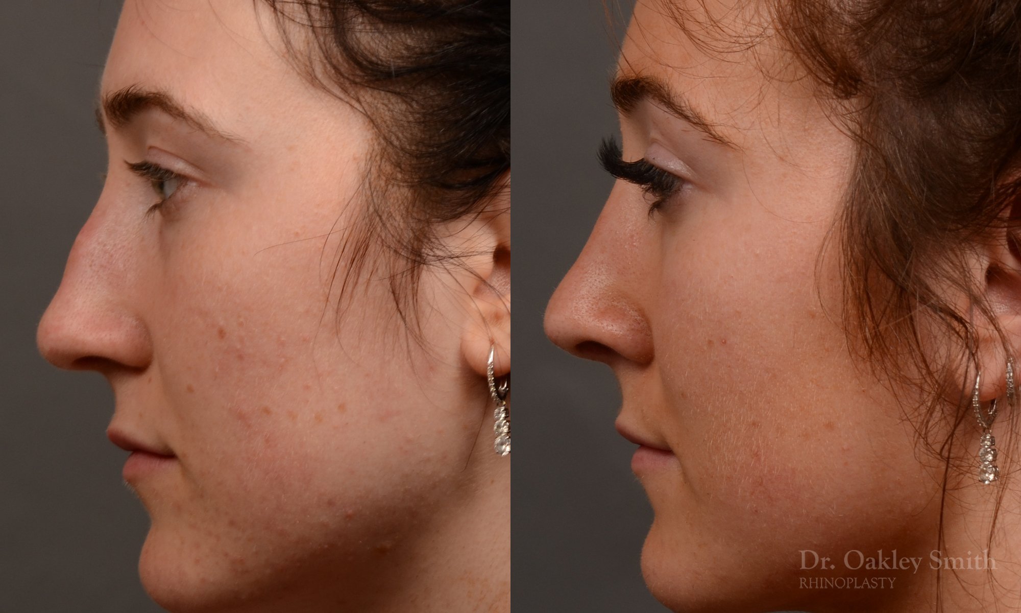 484E-rhinoplasty-dr-oakley-smith-toronto-top-surgeon-nose-job.jpg