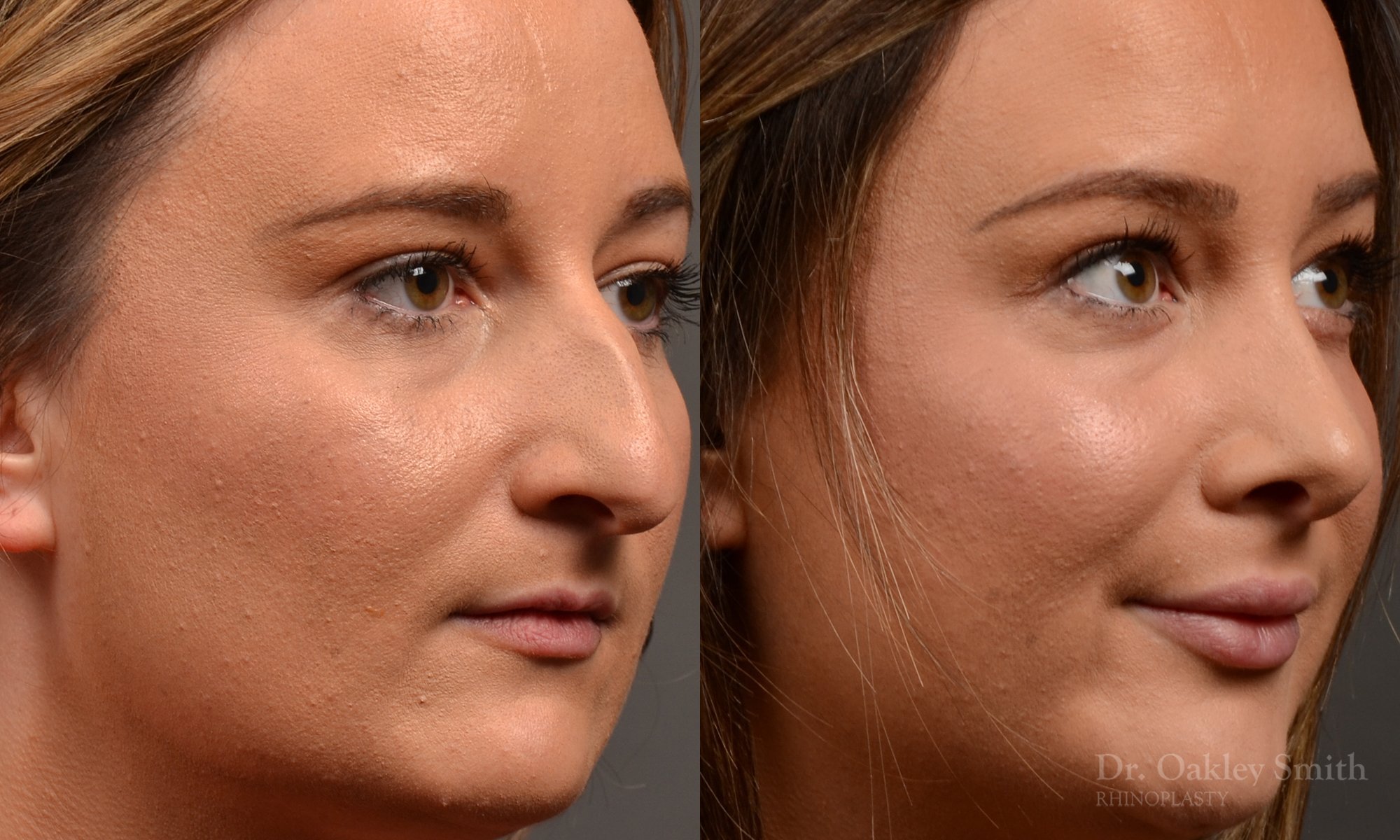 478B-rhinoplasty-dr-oakley-smith-toronto-top-surgeon-nose-job.jpg