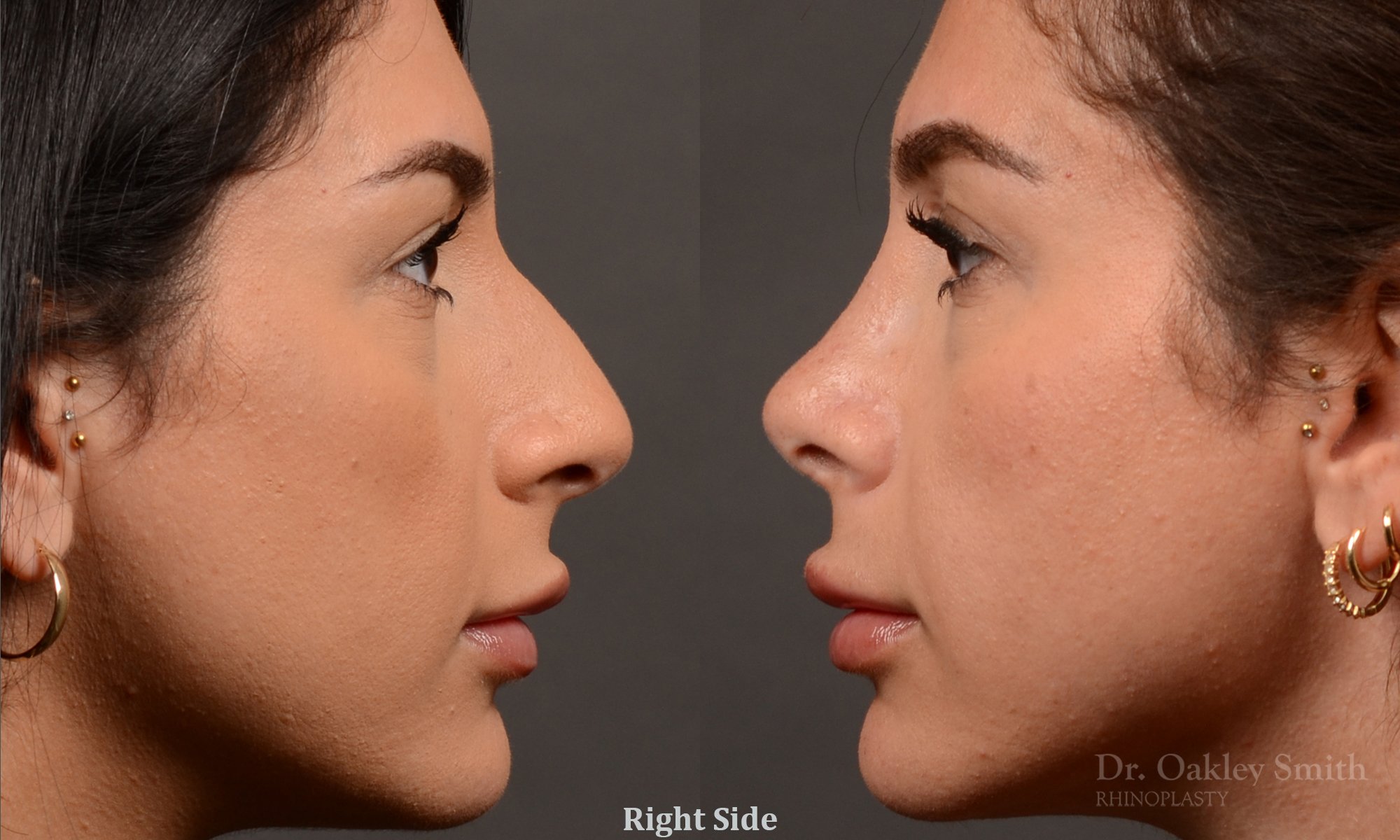 540C-rhinoplasty-dr-oakley-smith-toronto-nose-job.jpg