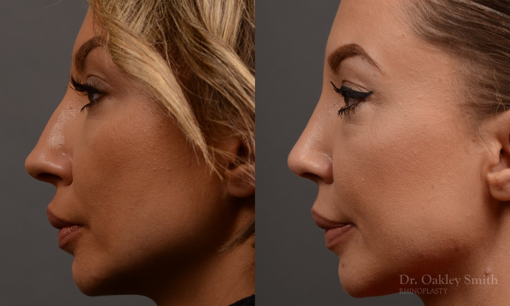 354E-rhinoplasty-dr-oakley-smith-toronto-nose-job.jpg
