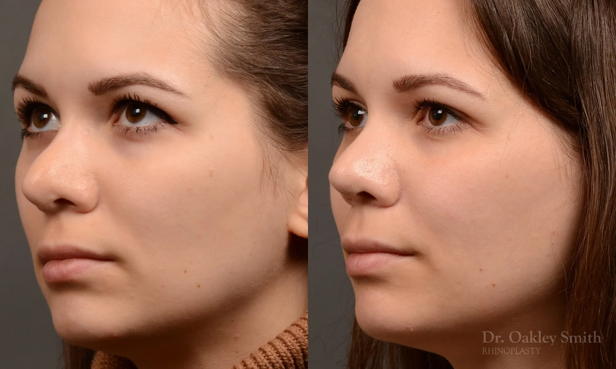 542D-rhinoplasty-before-and-after-nose-job-toronto-Dr.-Oakley-Smith.jpg