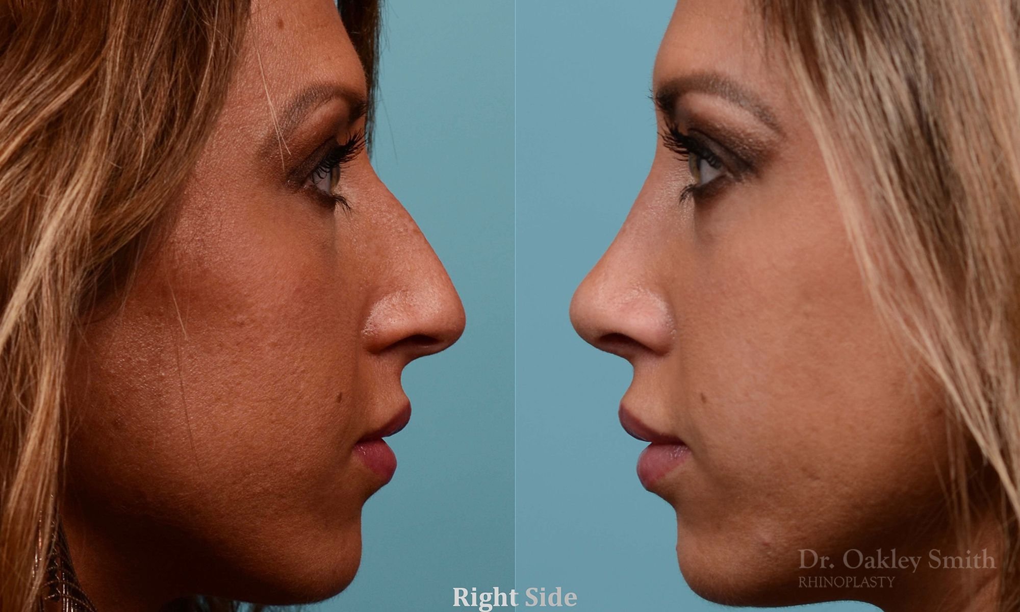 208: Female, Ethnic Rhinoplasty, Thin Skin, Dorsal Hump Curve, Tip Refinement