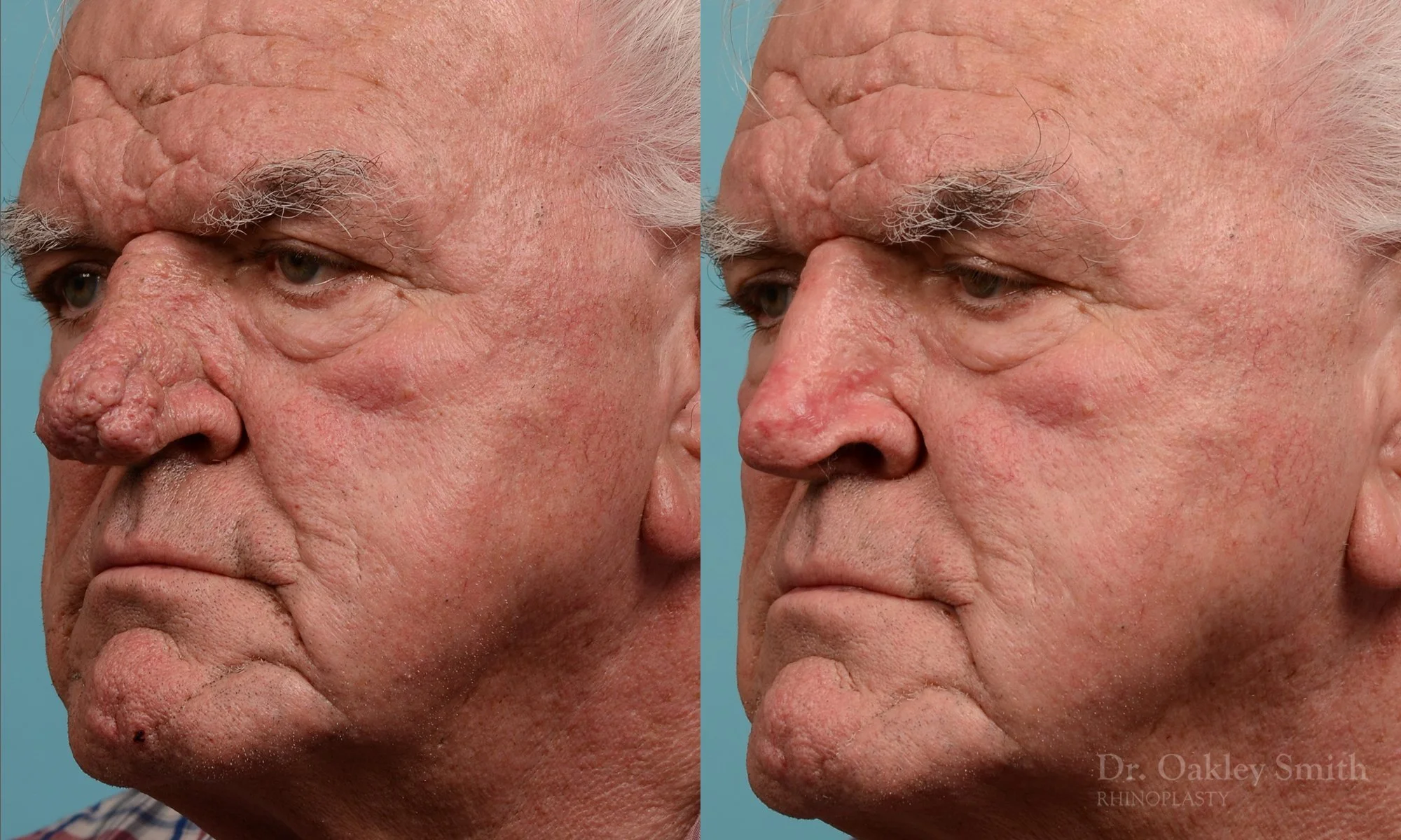 245D-rhinophyma-nose-job-rhinoplasty-dr-oakley-smith-toronto-1.jpg