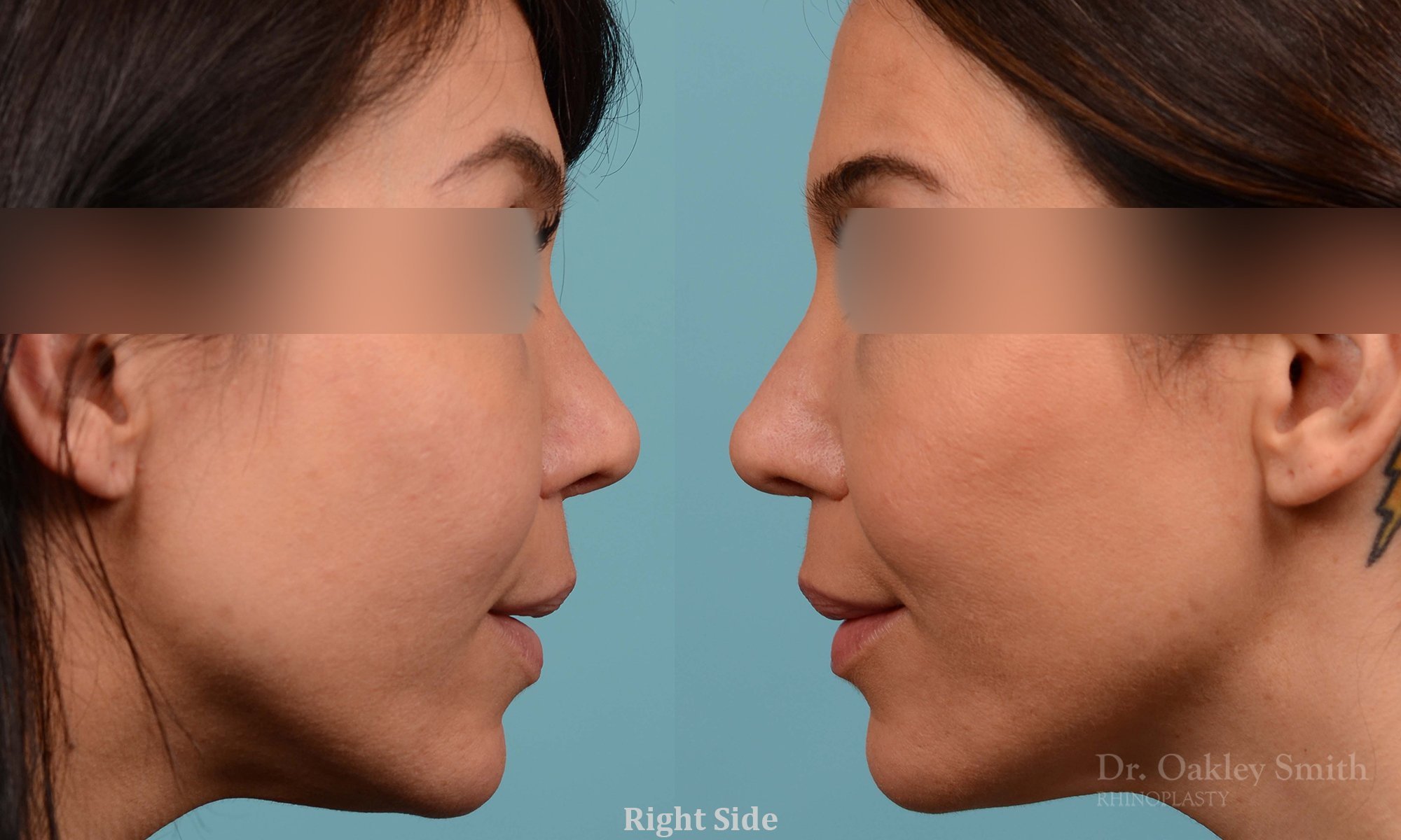 219: Female, Revision Rhinoplasty, Thick Skin, Tip Reconstruction
