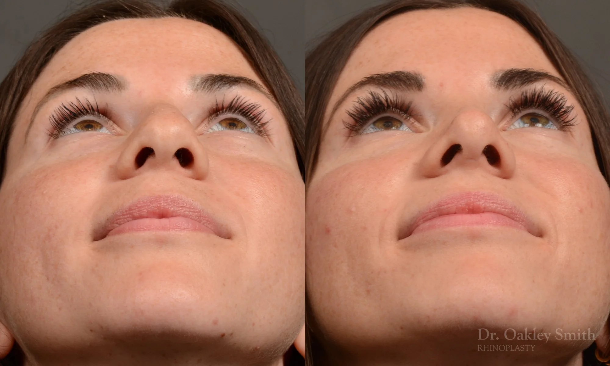 481F-rhinoplasty-dr-oakley-smith-toronto-top-surgeon-nose-job.jpg