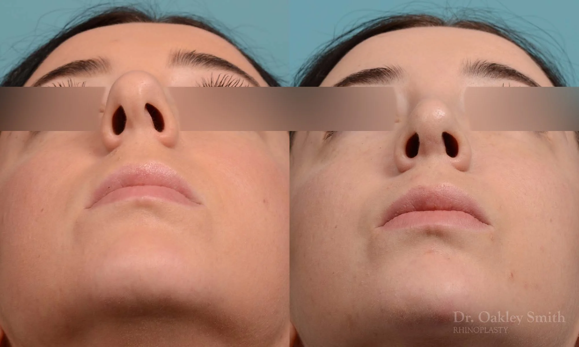 283F-rhinoplasty-dr-oakley-smith-toronto-nose-job (1).jpg