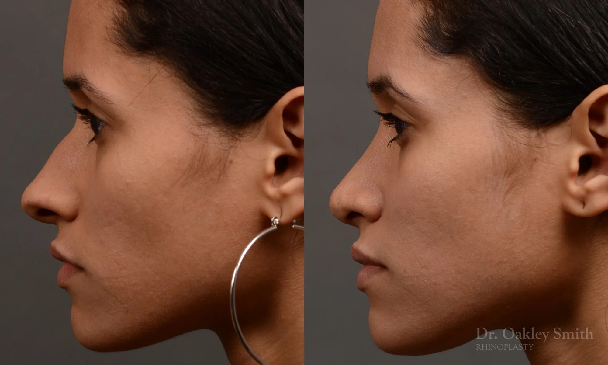 330E-rhinoplasty-dr-oakley-smith-toronto-nose-job.jpg