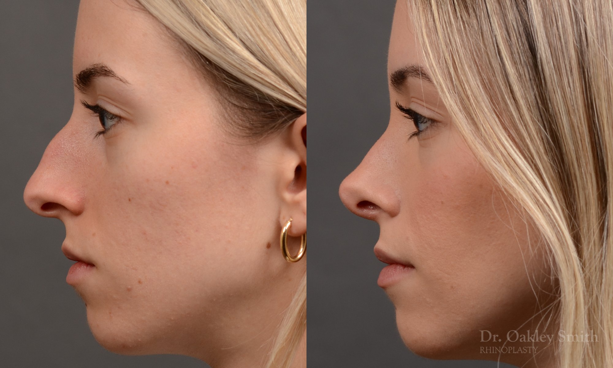 531BE-hinoplasty-dr-oakley-smith-toronto-top-surgeon-nose-job.jpg