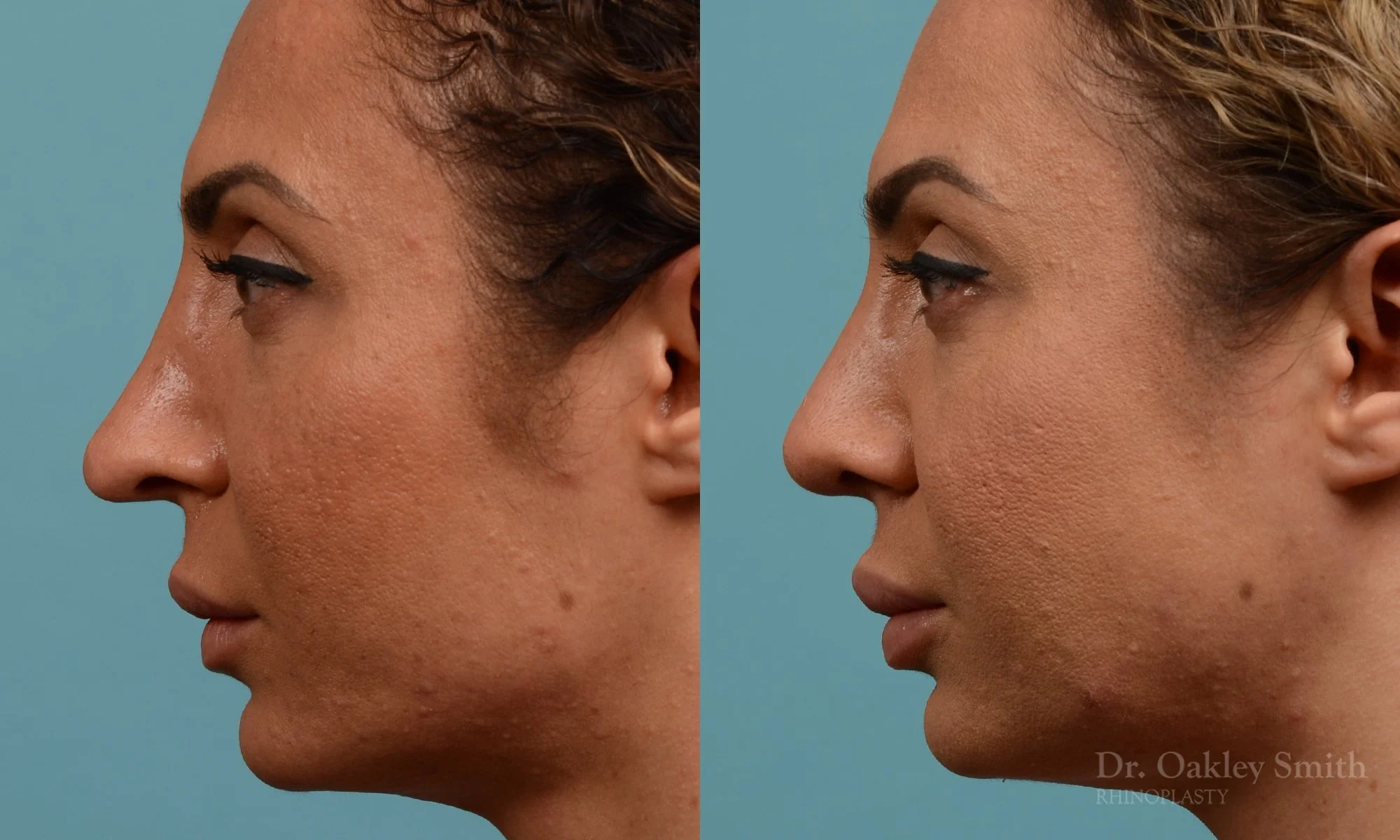 338E-rhinoplasty-dr-oakley-smith-toronto-nose-job.jpg