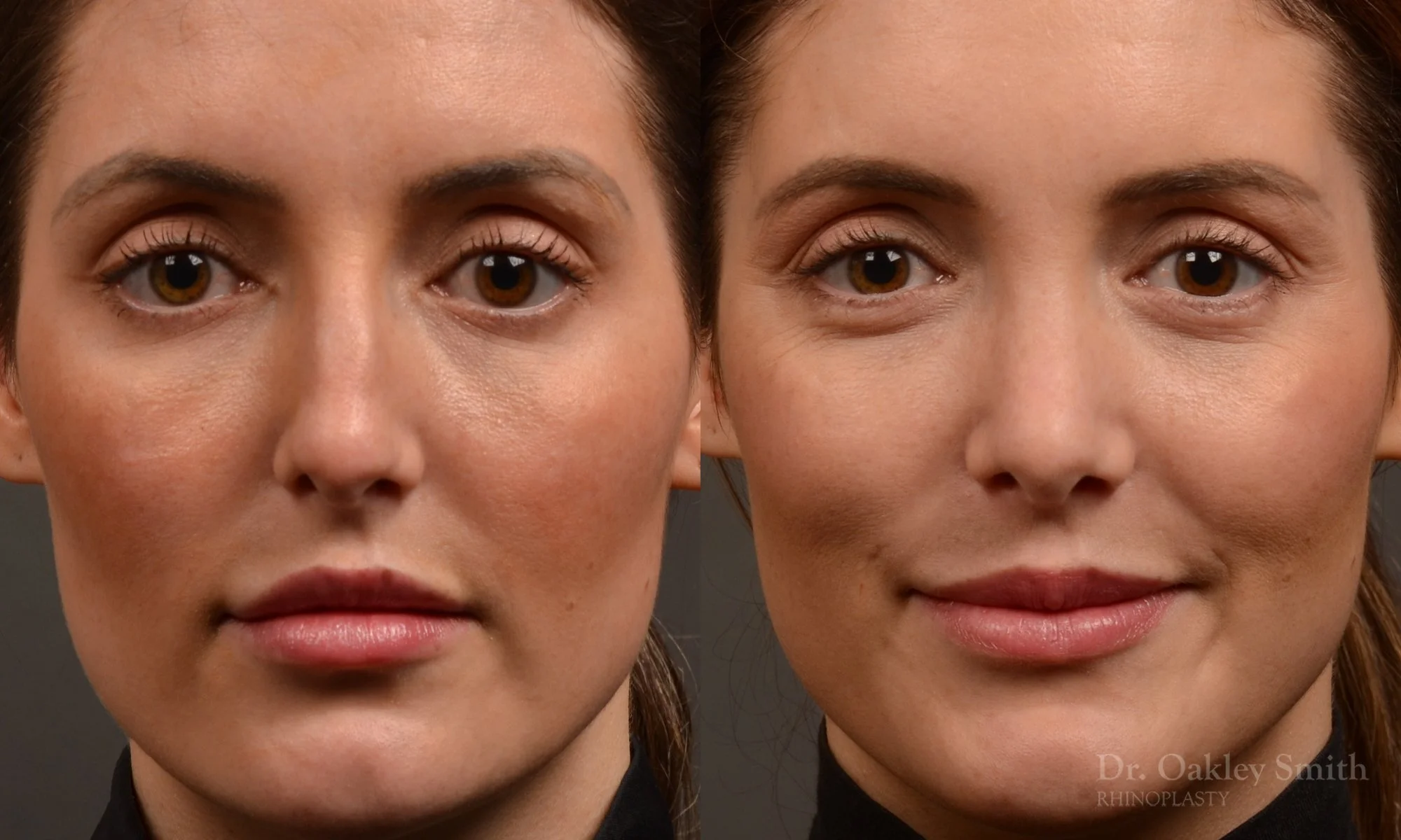 490A-rhinoplasty-dr-oakley-smith-toronto-top-surgeon-nose-job.jpg