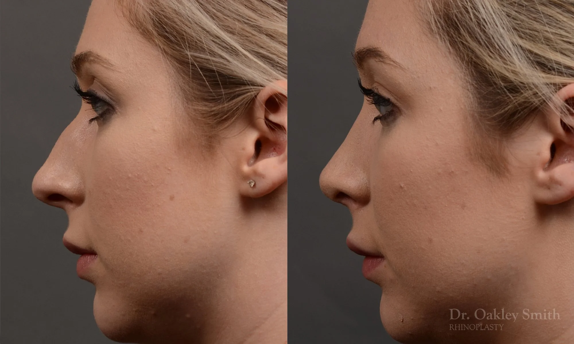 348E-rhinoplasty-dr-oakley-smith-toronto-nose-job.jpg