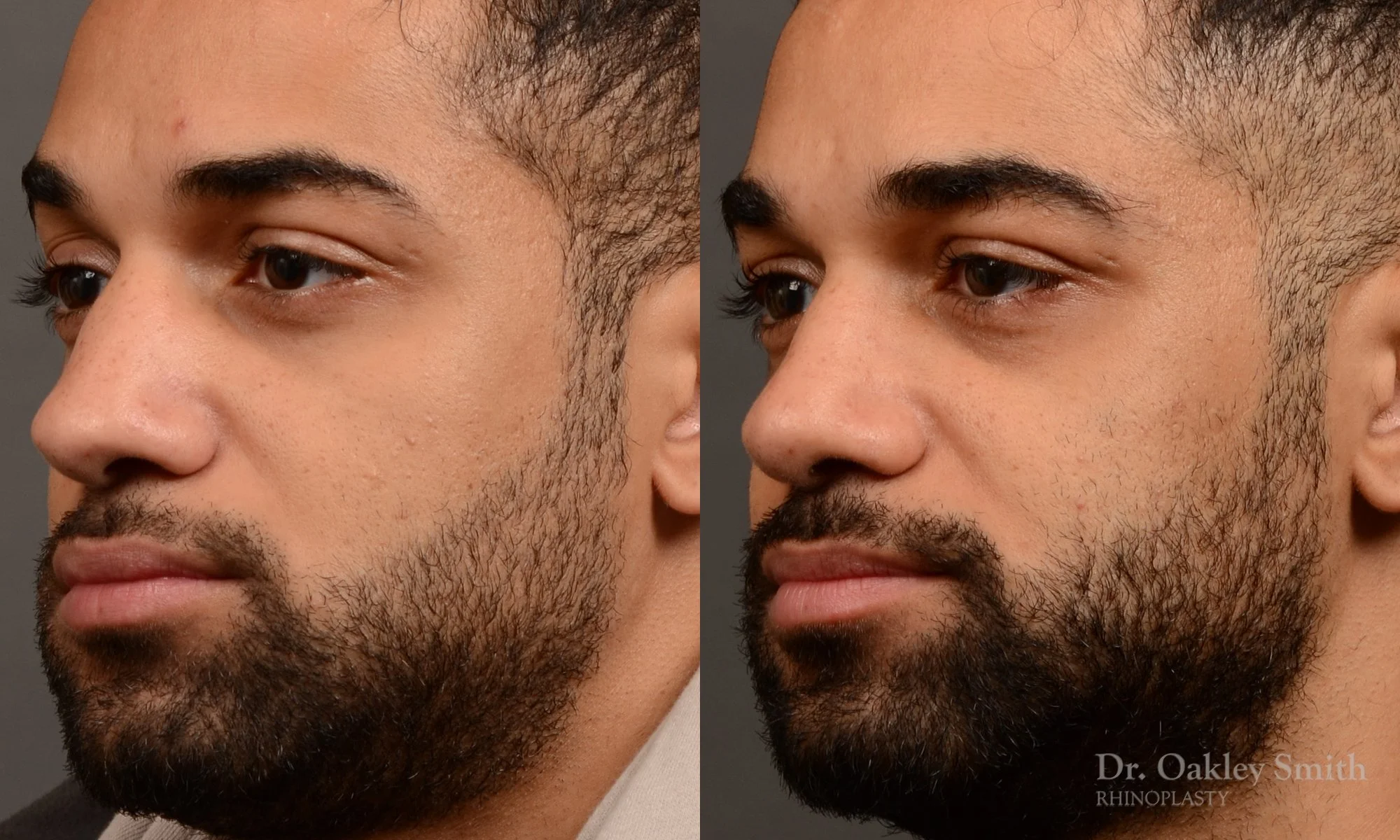 544D-male-rhinoplasty-before-and-after-nose-job-toronto-Dr.-Oakley-Smith.jpg