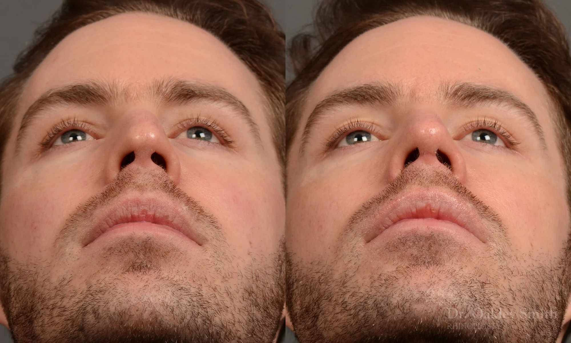337F-rhinoplasty-dr-oakley-smith-toronto-nose-job.jpg