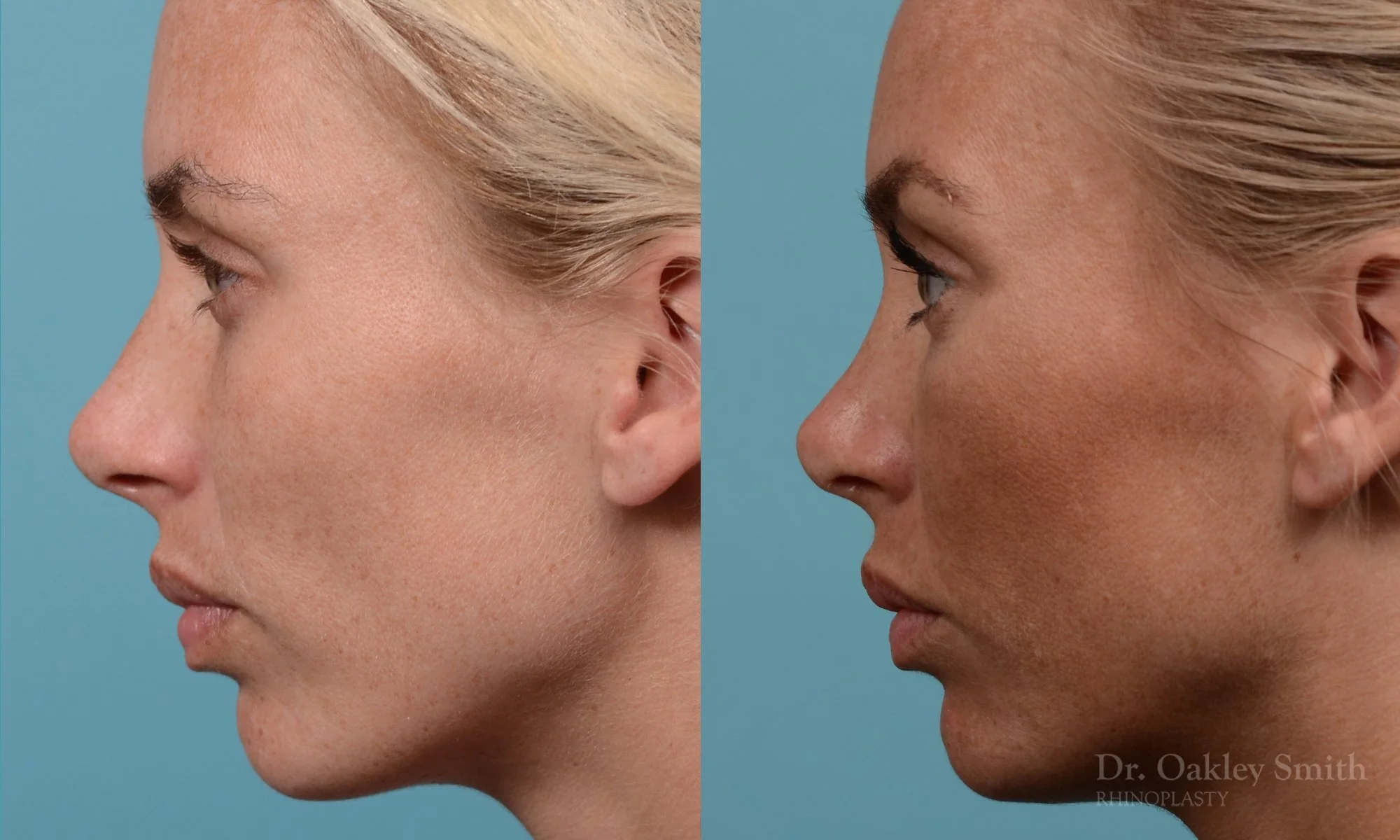 284E-rhinoplasty-dr-oakley-smith-toronto-nose-job.jpg