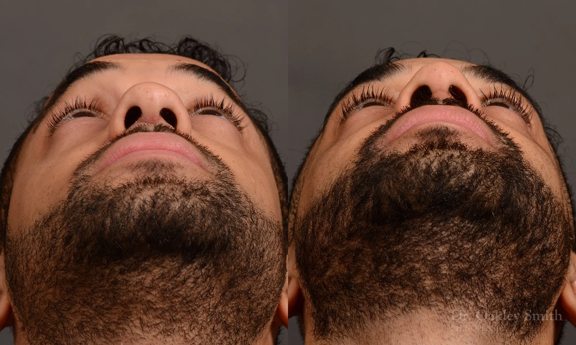 544F-male-rhinoplasty-before-and-after-nose-job-toronto-Dr.-Oakley-Smith.jpg