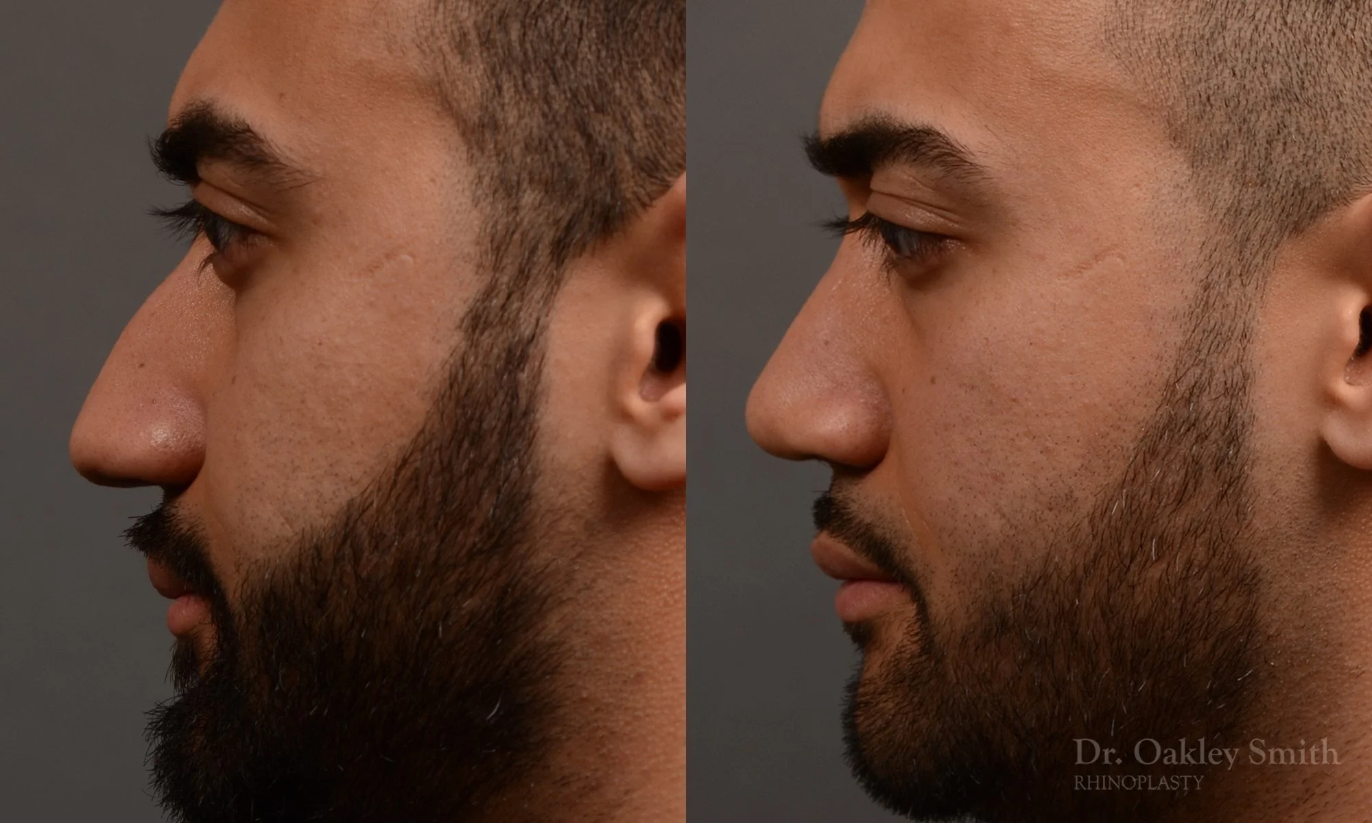 362.1E-rhinoplasty-dr-oakley-smith-toronto-nose-job.jpg