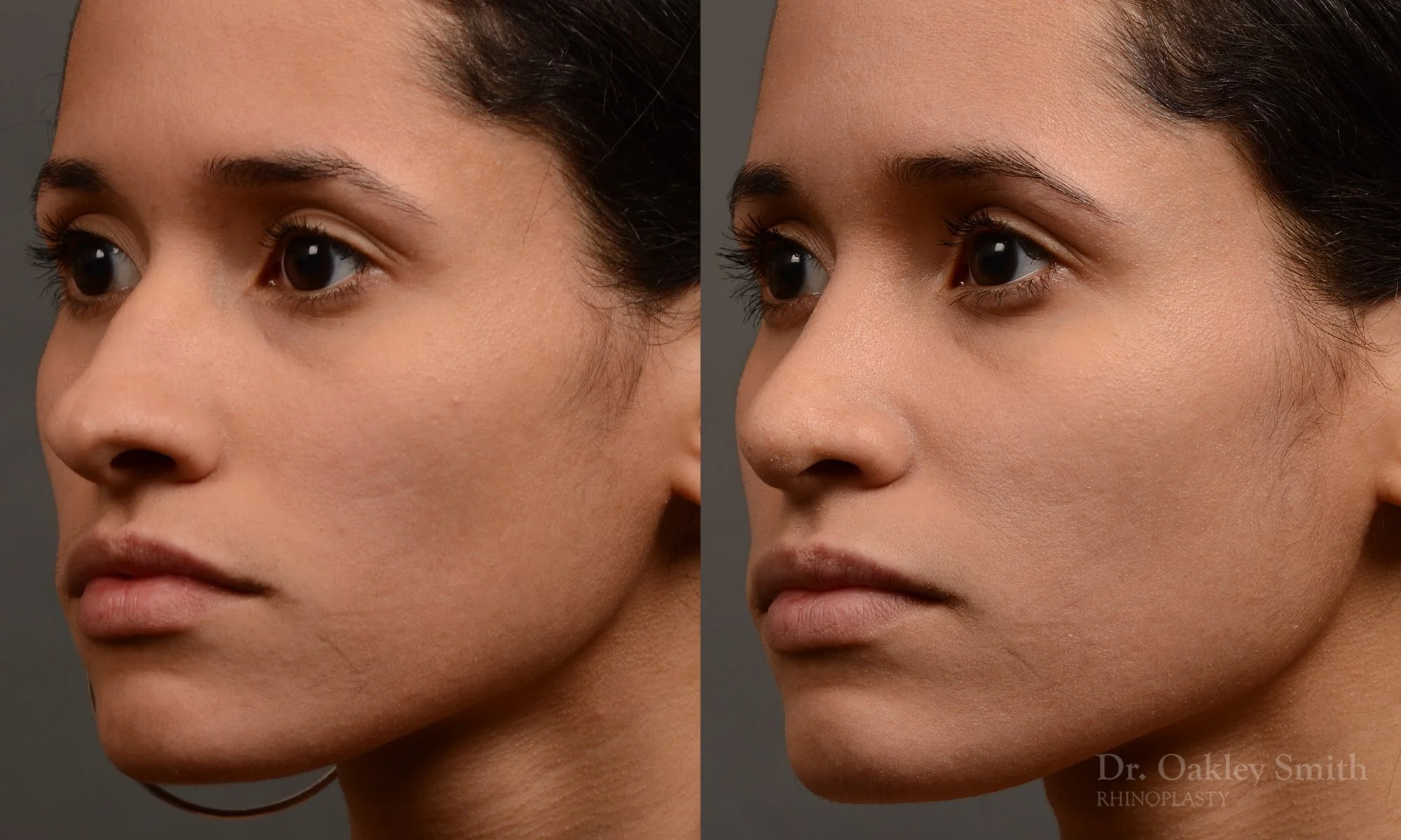 330D-rhinoplasty-dr-oakley-smith-toronto-nose-job.jpg