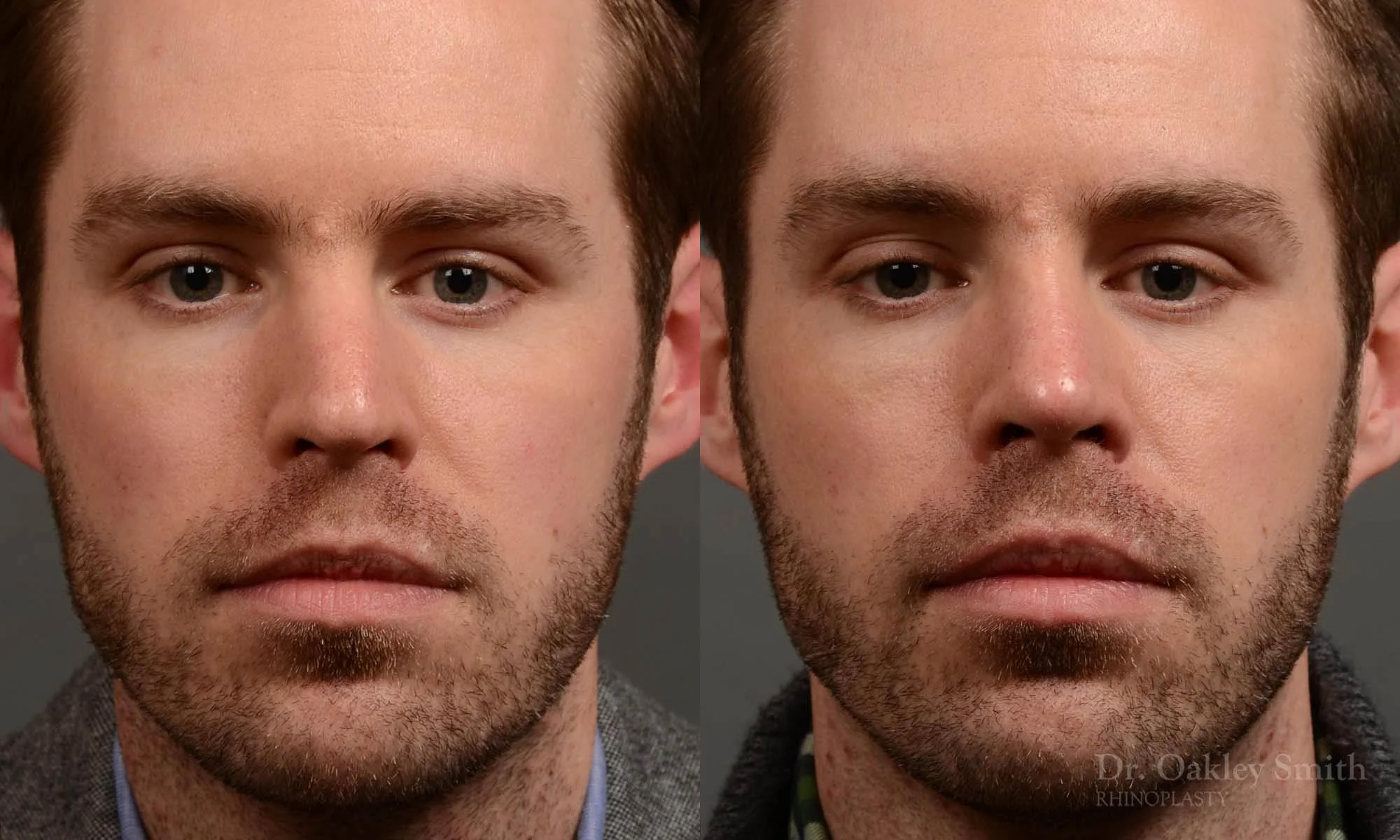337A-rhinoplasty-dr-oakley-smith-toronto-nose-job-1.jpg