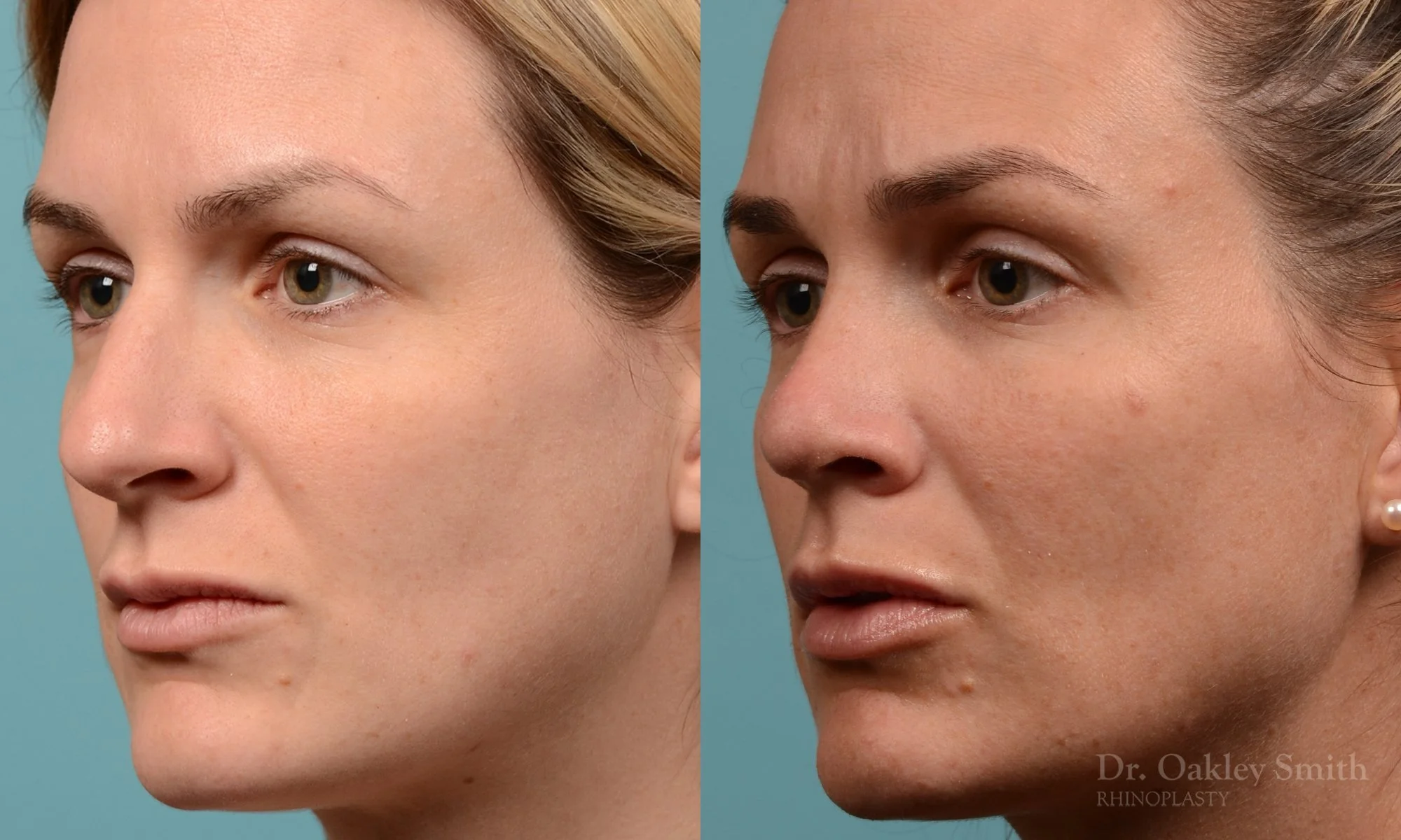 312D-rhinoplasty-dr-oakley-smith-toronto-nose-job.jpg