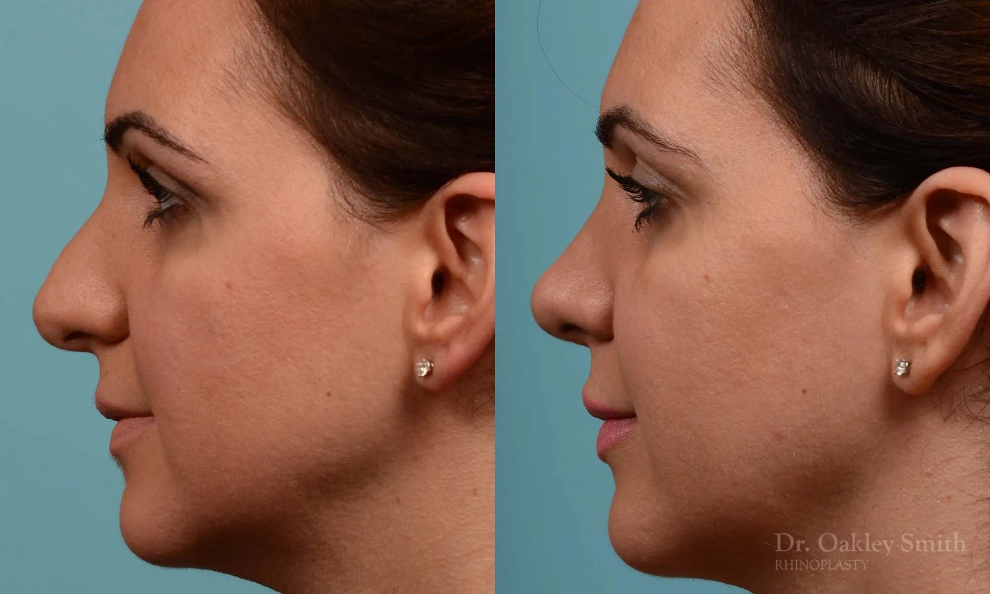 311E-rhinoplasty-dr-oakley-smith-toronto-nose-job.jpg