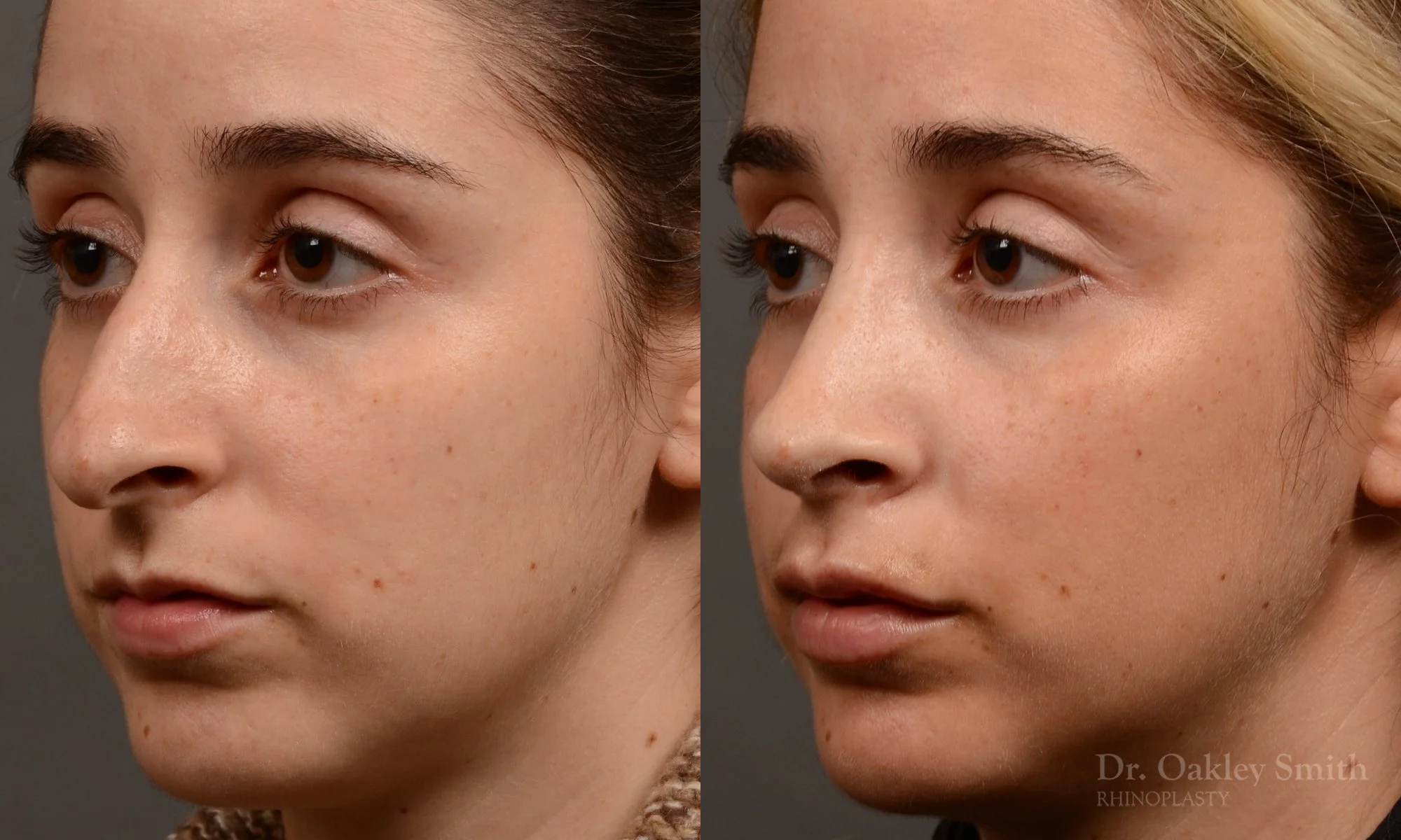 286D-rhinoplasty-dr-oakley-smith-toronto-nose-job.jpg