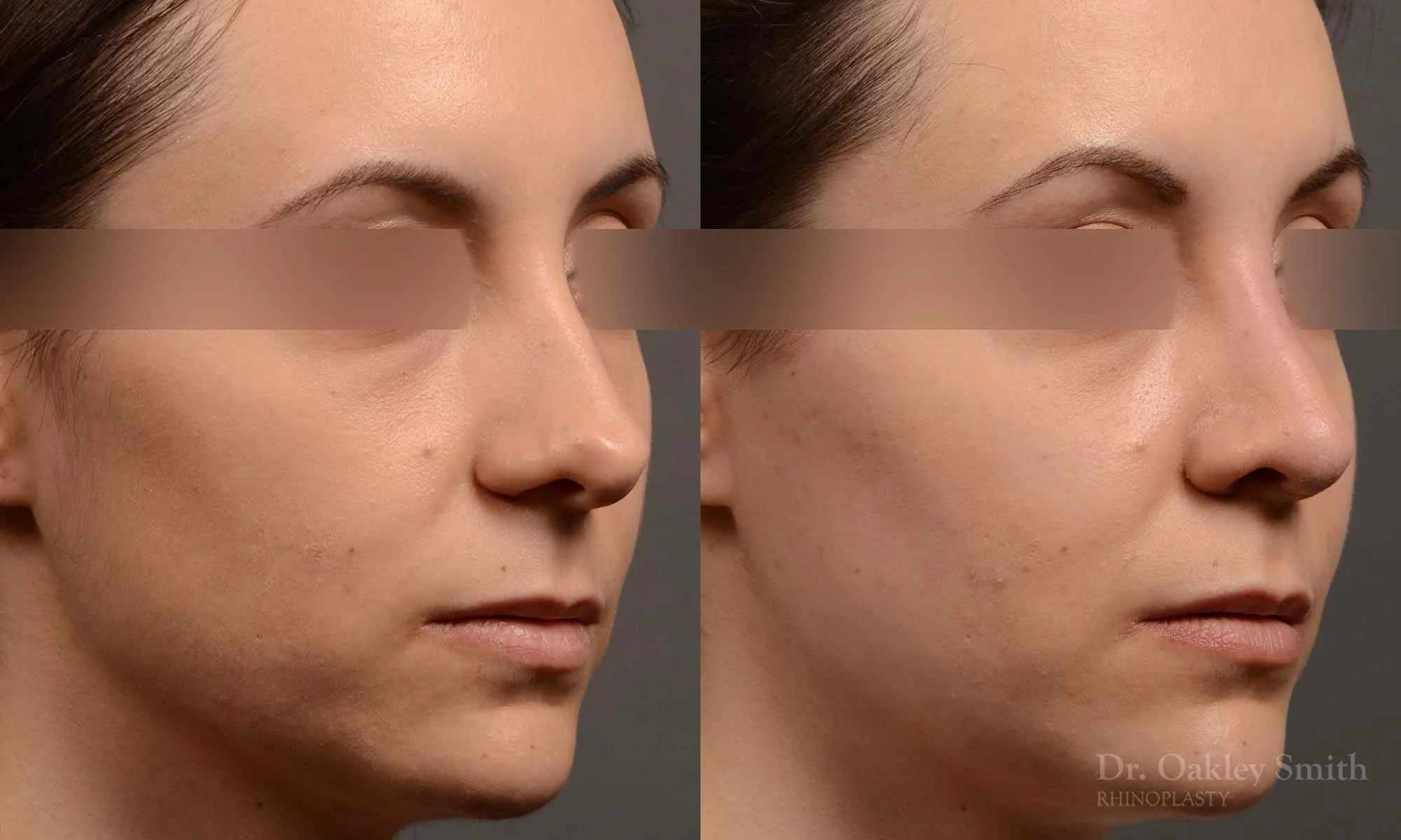 341B-rhinoplasty-dr-oakley-smith-toronto-nose-job.jpg