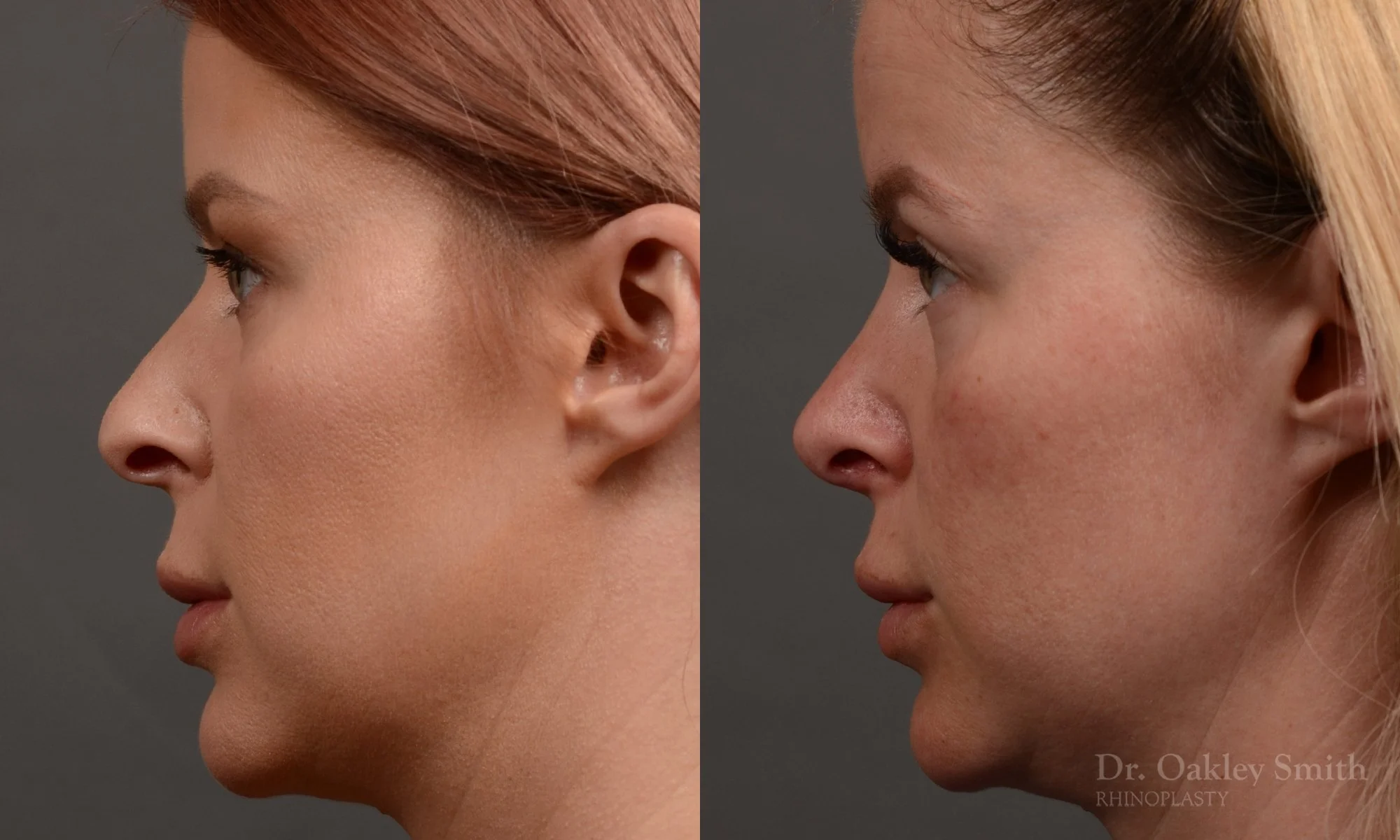 361E-rhinoplasty-dr-oakley-smith-toronto-nose-job.jpg