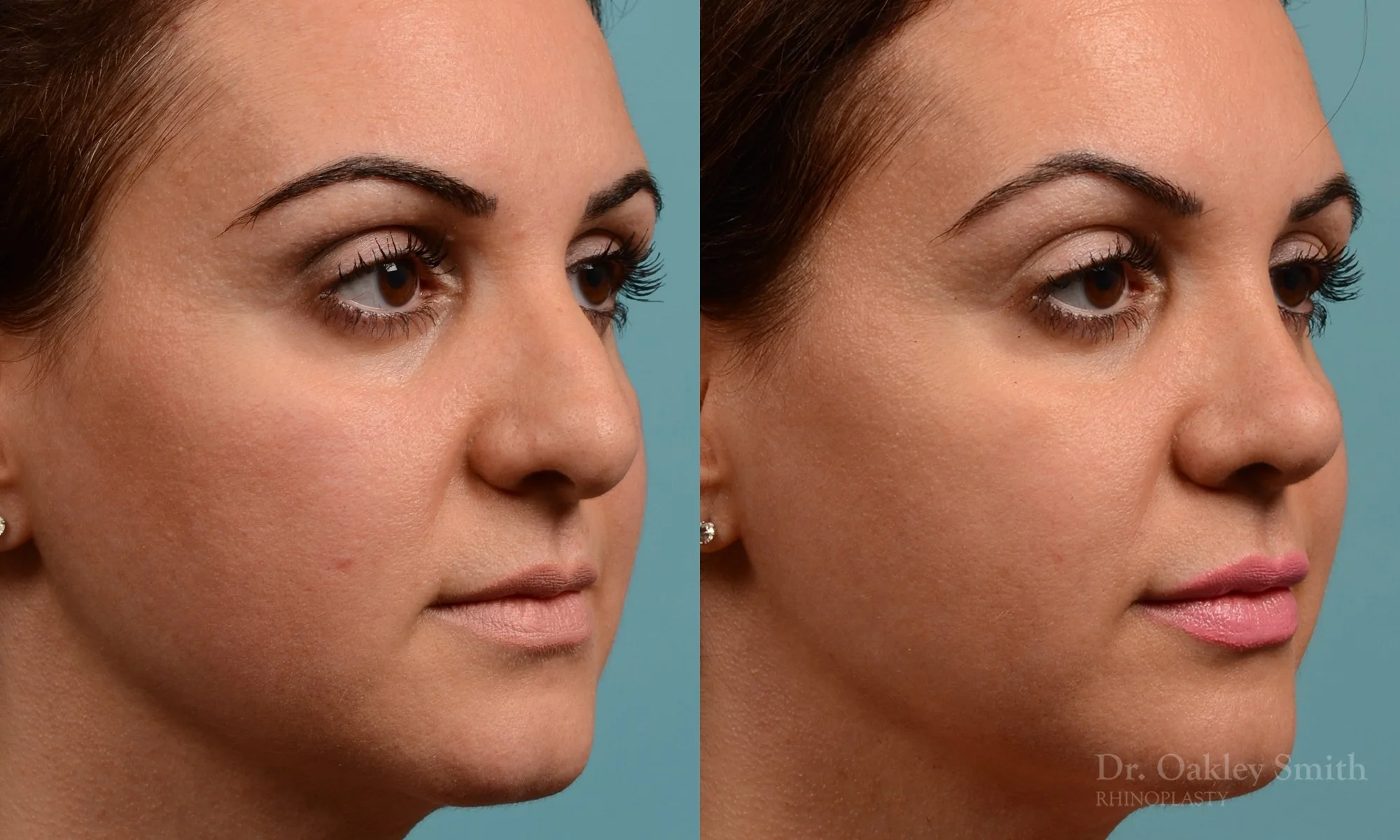 311B-rhinoplasty-dr-oakley-smith-toronto-nose-job.jpg